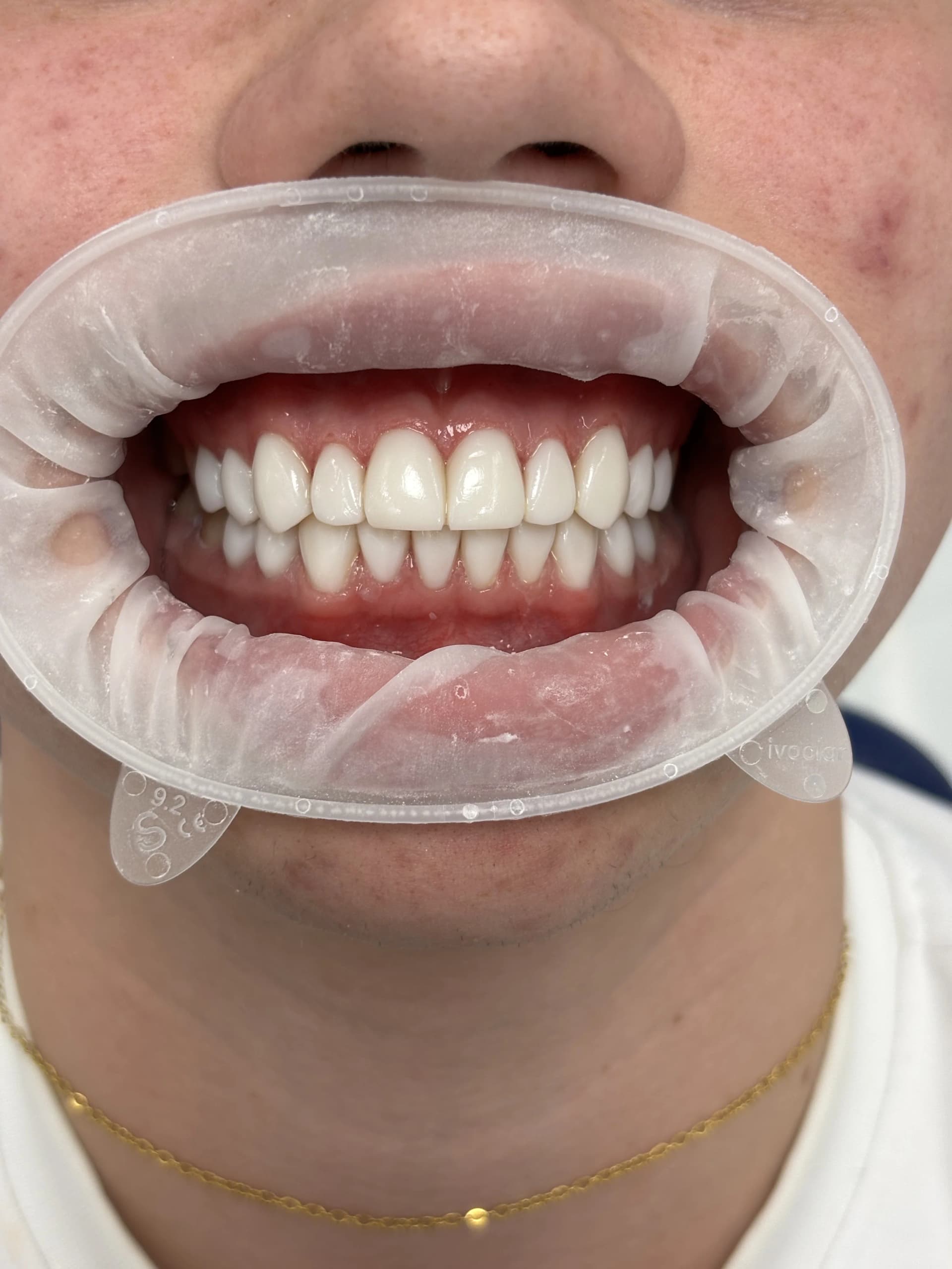 Smile makeover before — case 32, partner clinic, Istanbul
