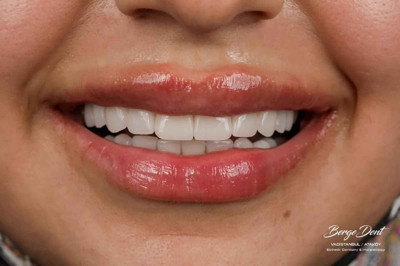 Porcelain veneers after result, close-up smile with white natural-looking teeth, Turkey dental clinic.