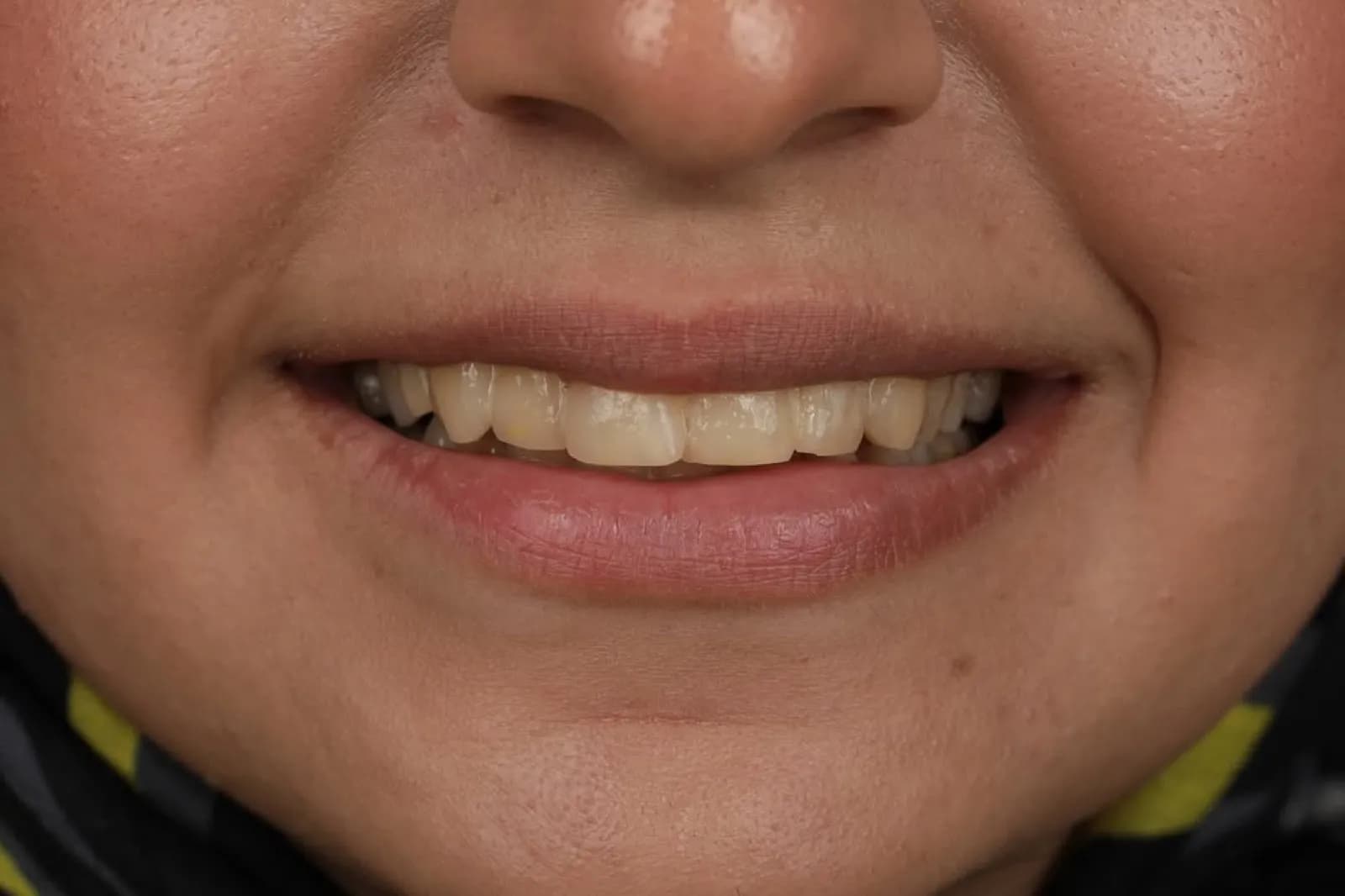 Before veneer treatment, close-up of discolored and unevenly shaped teeth, Turkey dental clinic.