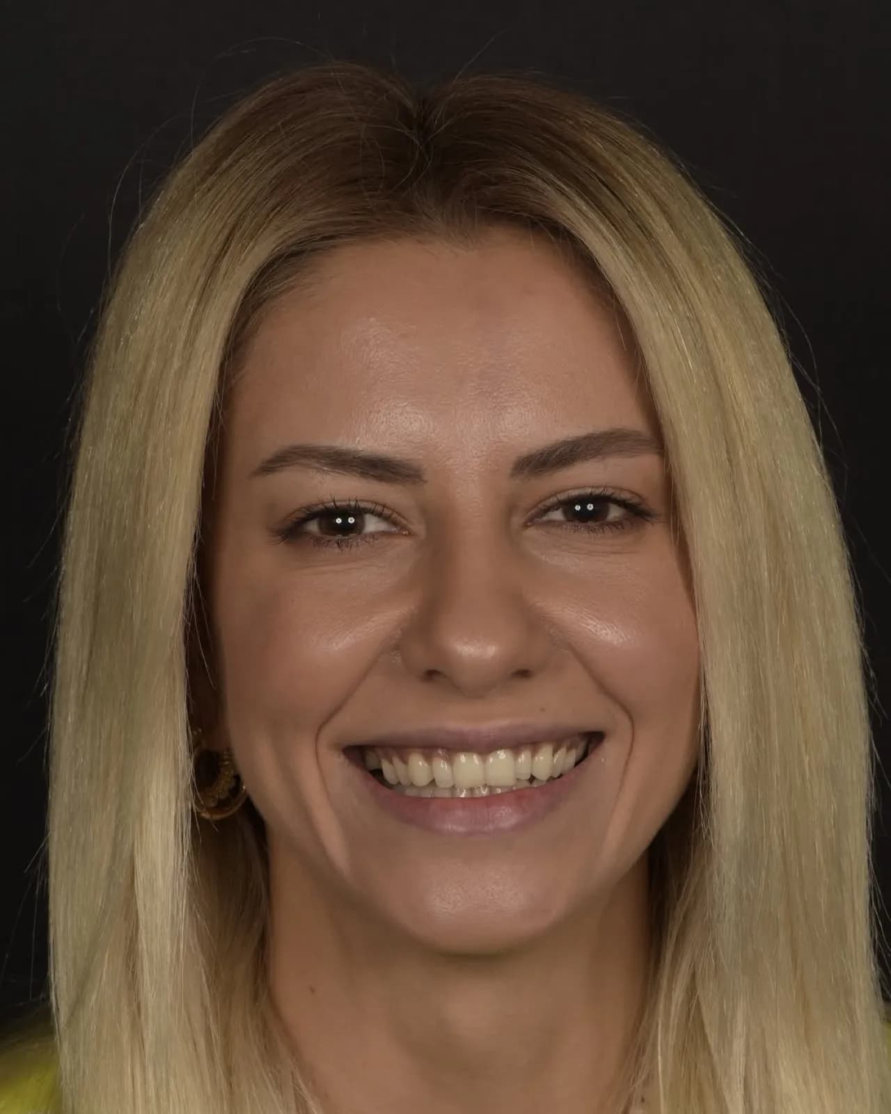 Before veneer treatment, full face portrait of female patient with natural smile, Turkey dental clinic.