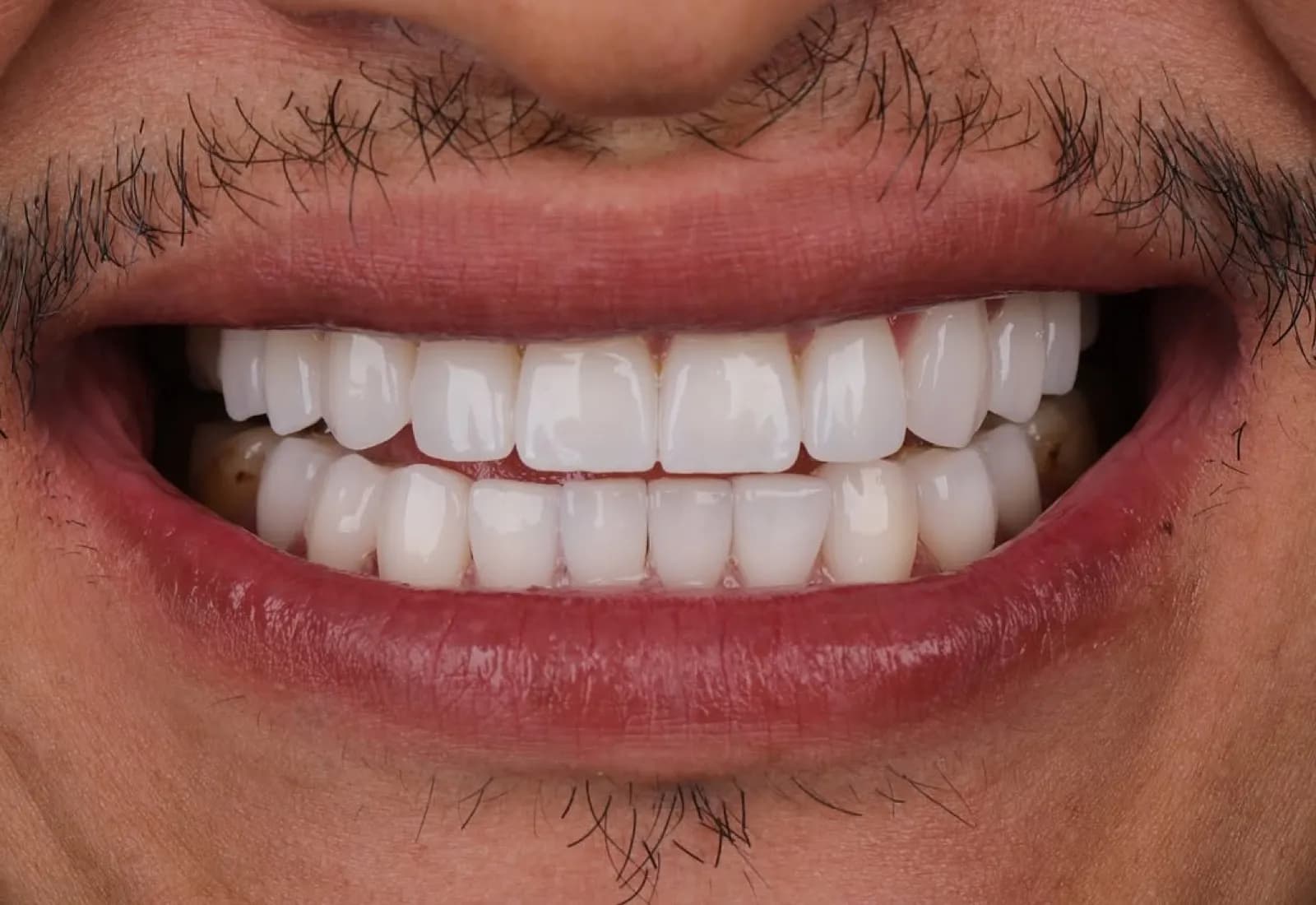 Porcelain veneers after result, close-up of white symmetrical smile, Turkey dental clinic.