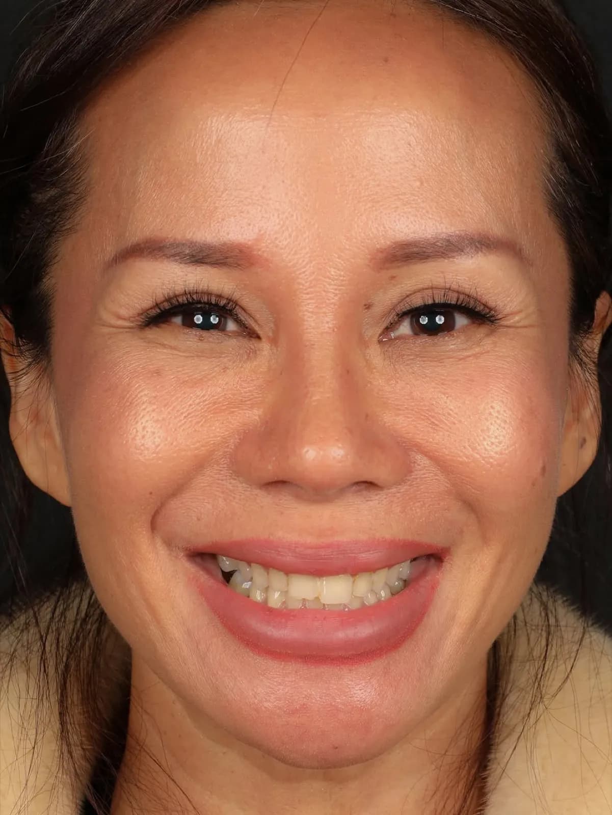 Before veneer treatment, full face portrait of mature female patient with natural smile, Turkey dental clinic.