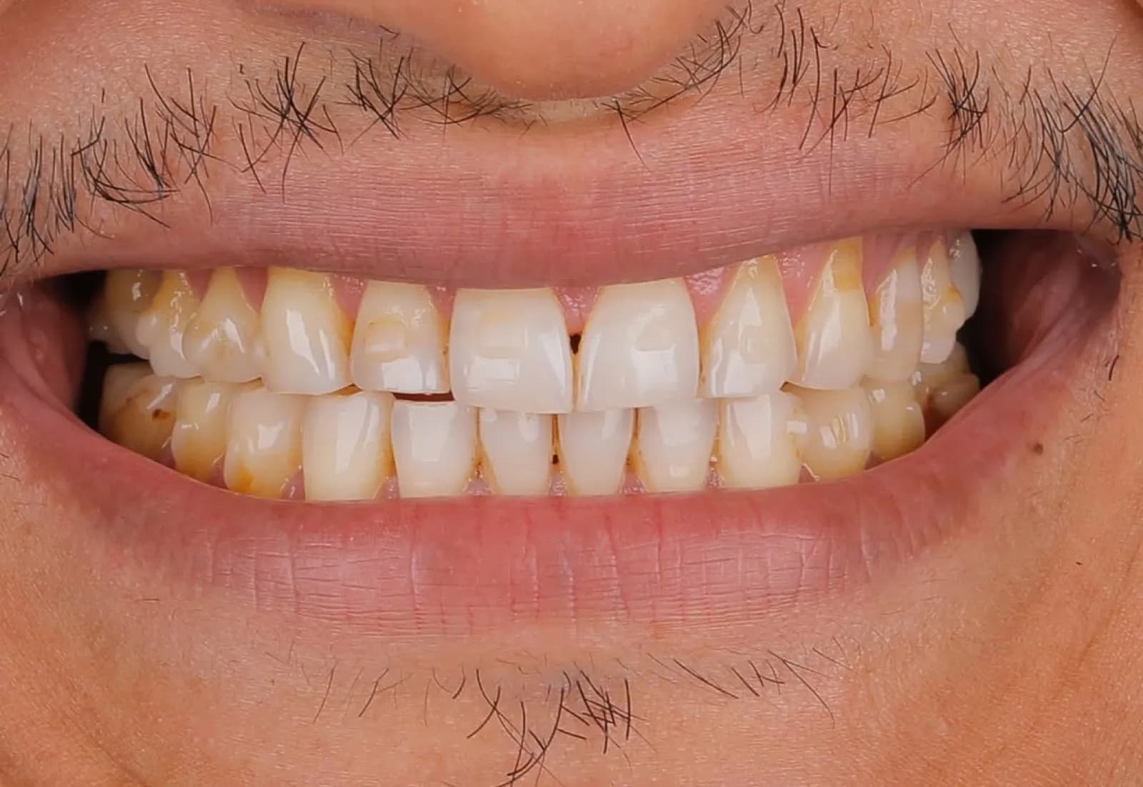 Porcelain veneers after result, full face portrait of mature female patient smiling, Turkey dental clinic.