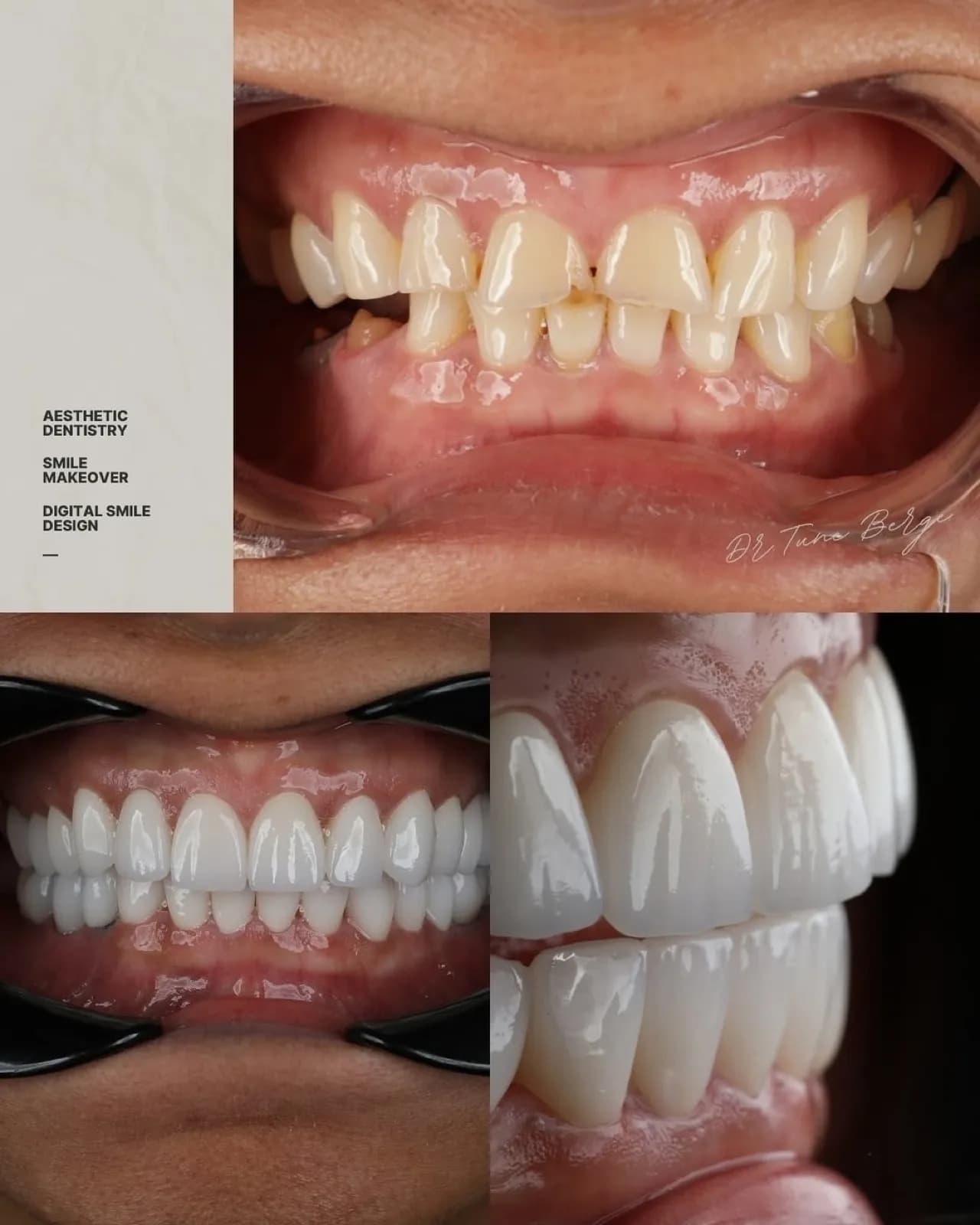 Before and after veneer treatment collage, close-up comparison of discolored teeth versus white porcelain veneers, Turkey dental clinic.