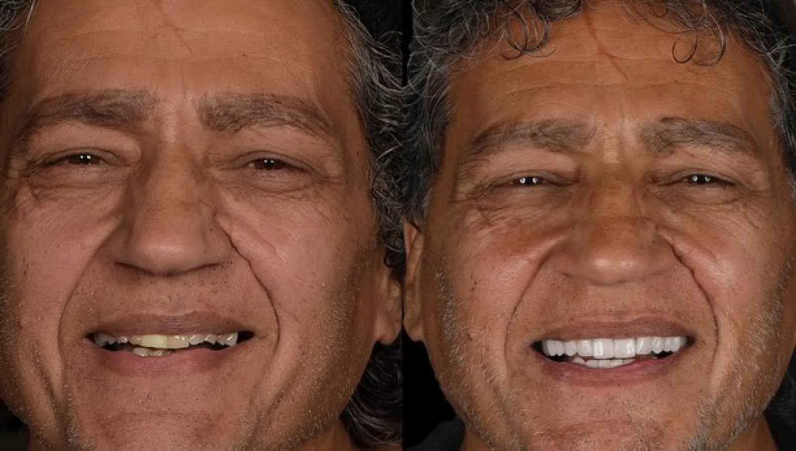 Before dental treatment, full face portrait of male patient with cap and worn teeth, Turkey dental clinic.