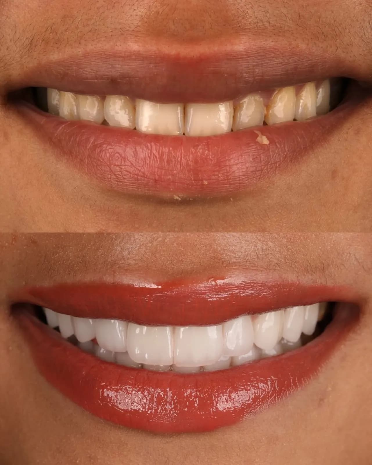 Laminate veneers before and after result, close-up comparison of yellowed versus white teeth, Turkey dental clinic.