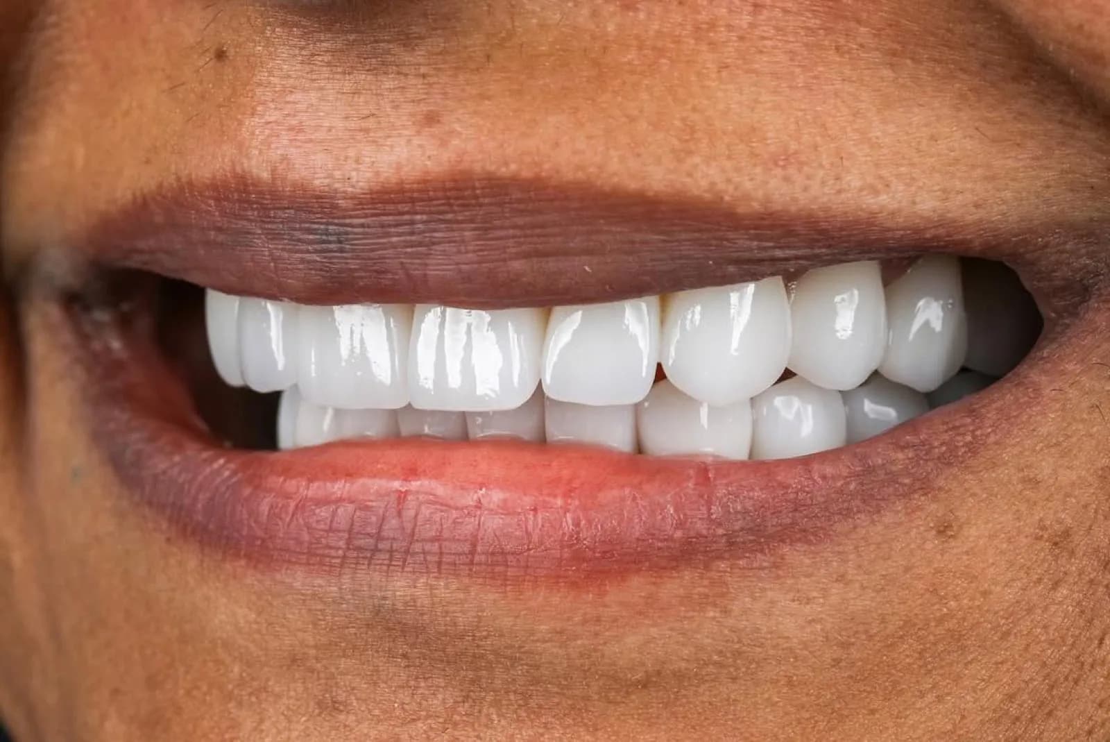 Porcelain veneers after result, close-up of straight white smile, Turkey dental clinic.