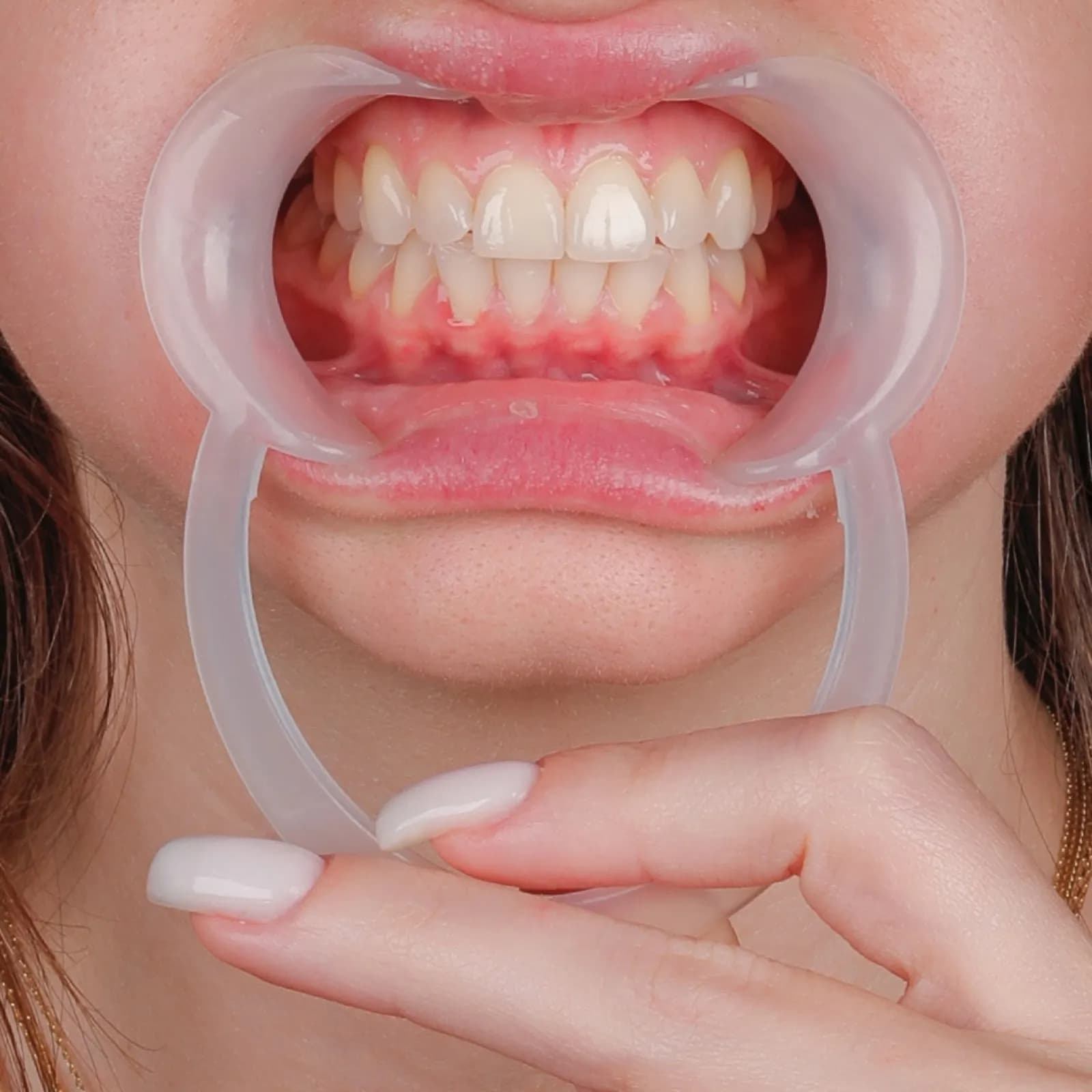 Before laminate veneer treatment, close-up of discolored teeth with dental retractor, Turkey dental clinic.