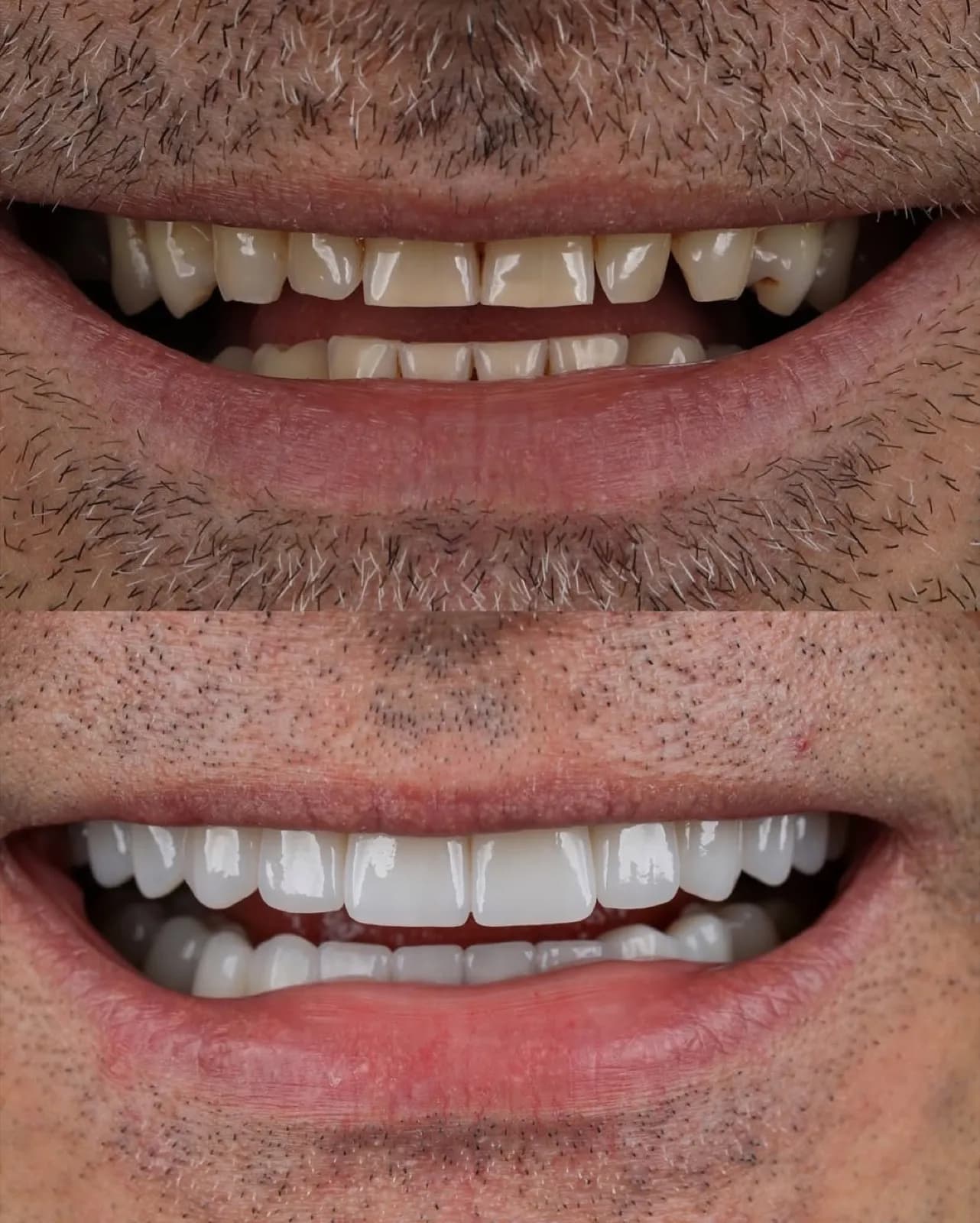 Before and after veneer treatment, close-up comparison of worn versus white porcelain teeth, Turkey dental clinic.