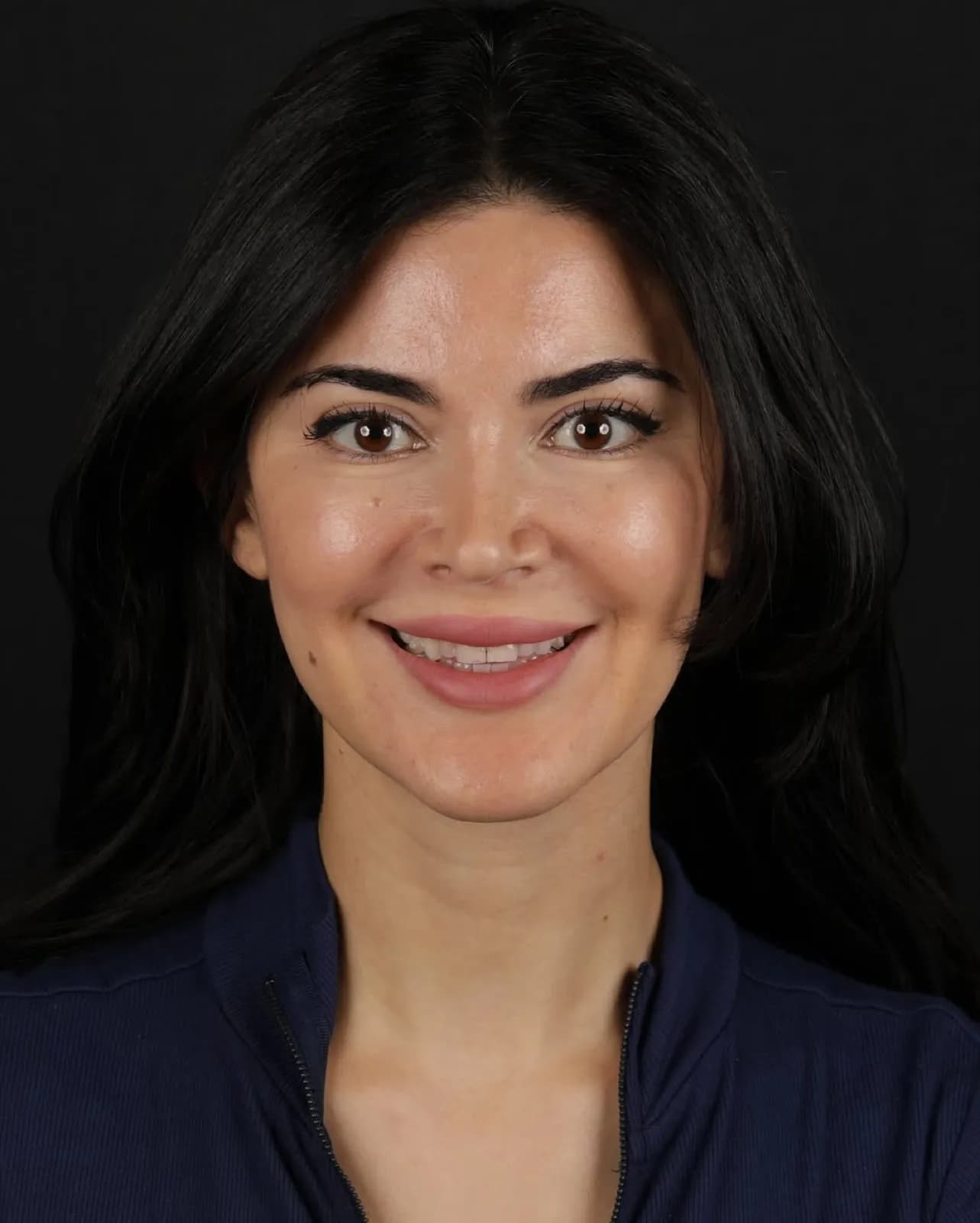 Before laminate veneer treatment, full face portrait of female patient with natural smile, Turkey dental clinic.