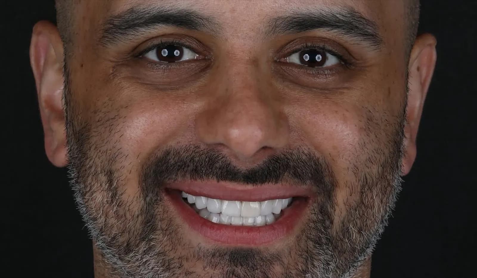 Porcelain veneers after result, full face portrait of male patient with beard smiling, Turkey dental clinic.