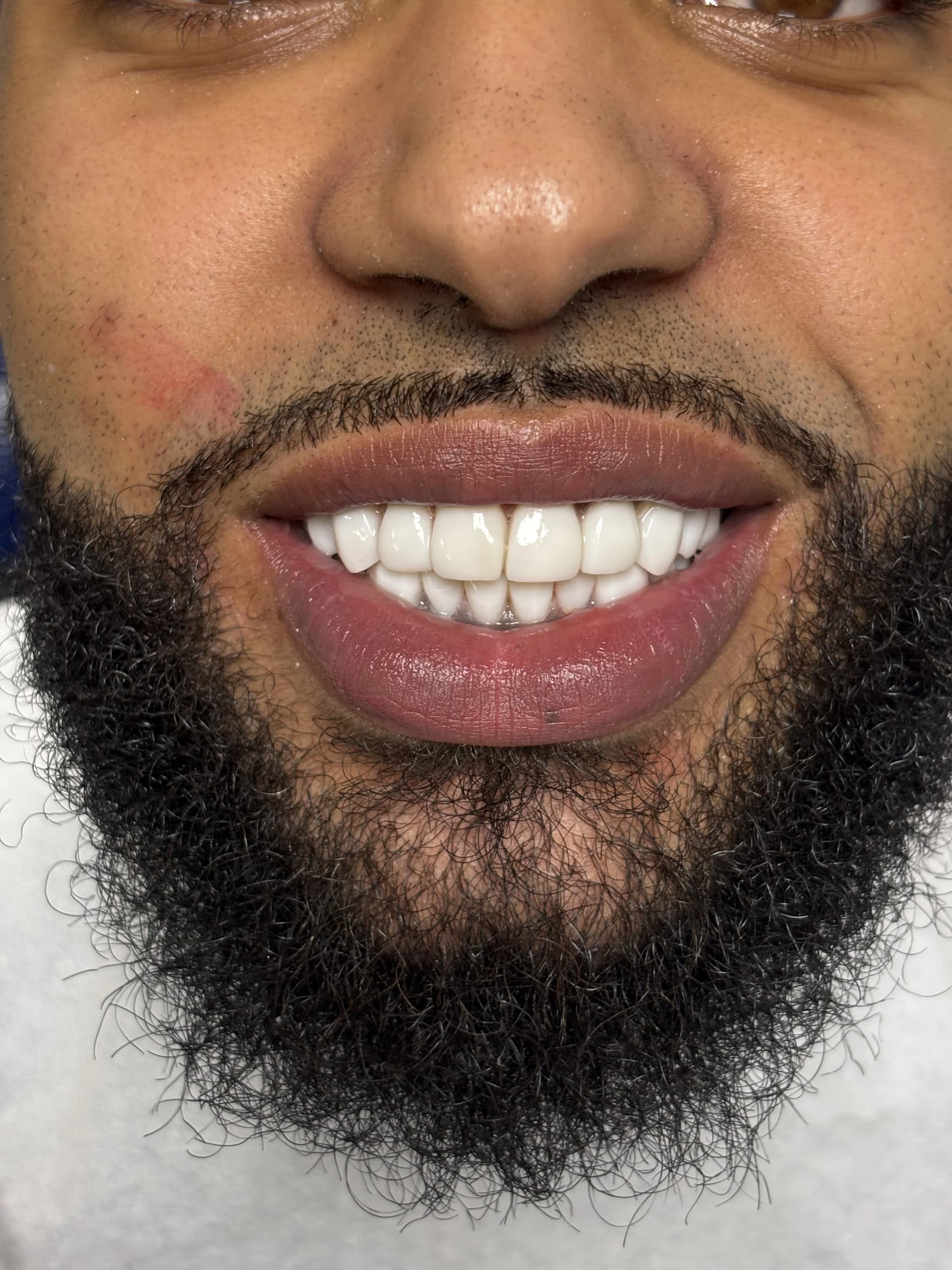 Composite bonding after case 1 — Istanbul NexWell
