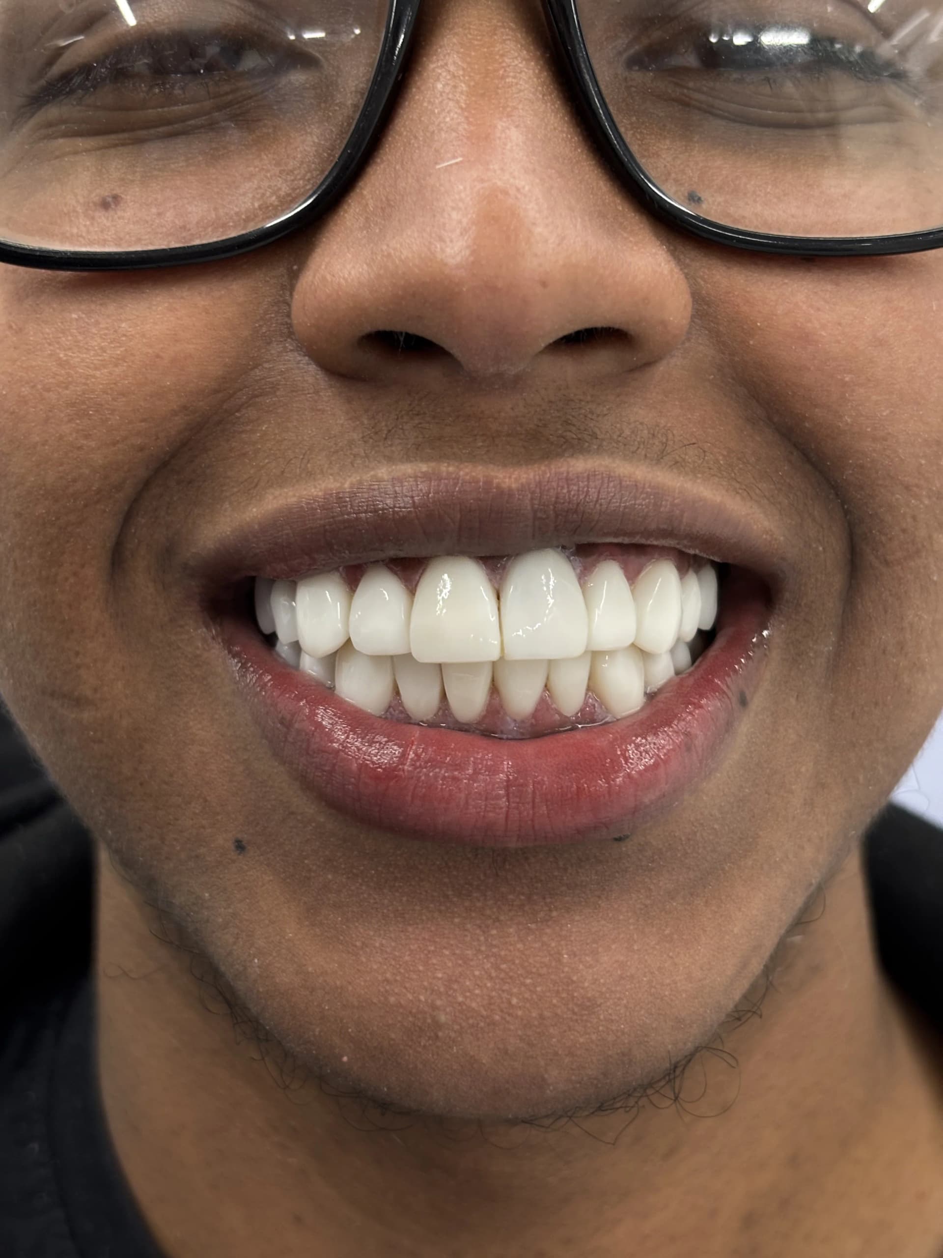 Composite bonding after case 2 — Istanbul NexWell