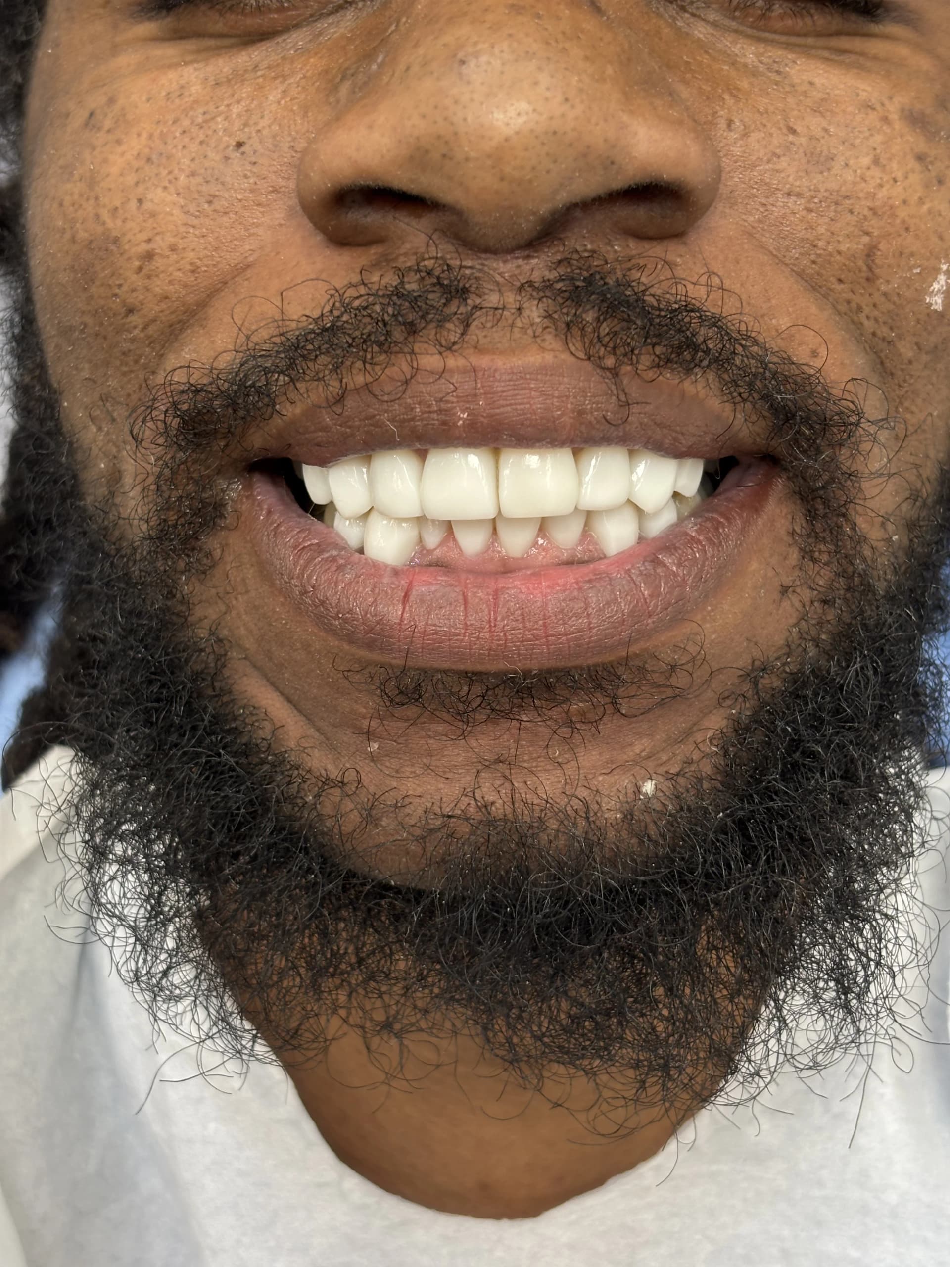 Composite bonding after case 3 — Istanbul NexWell