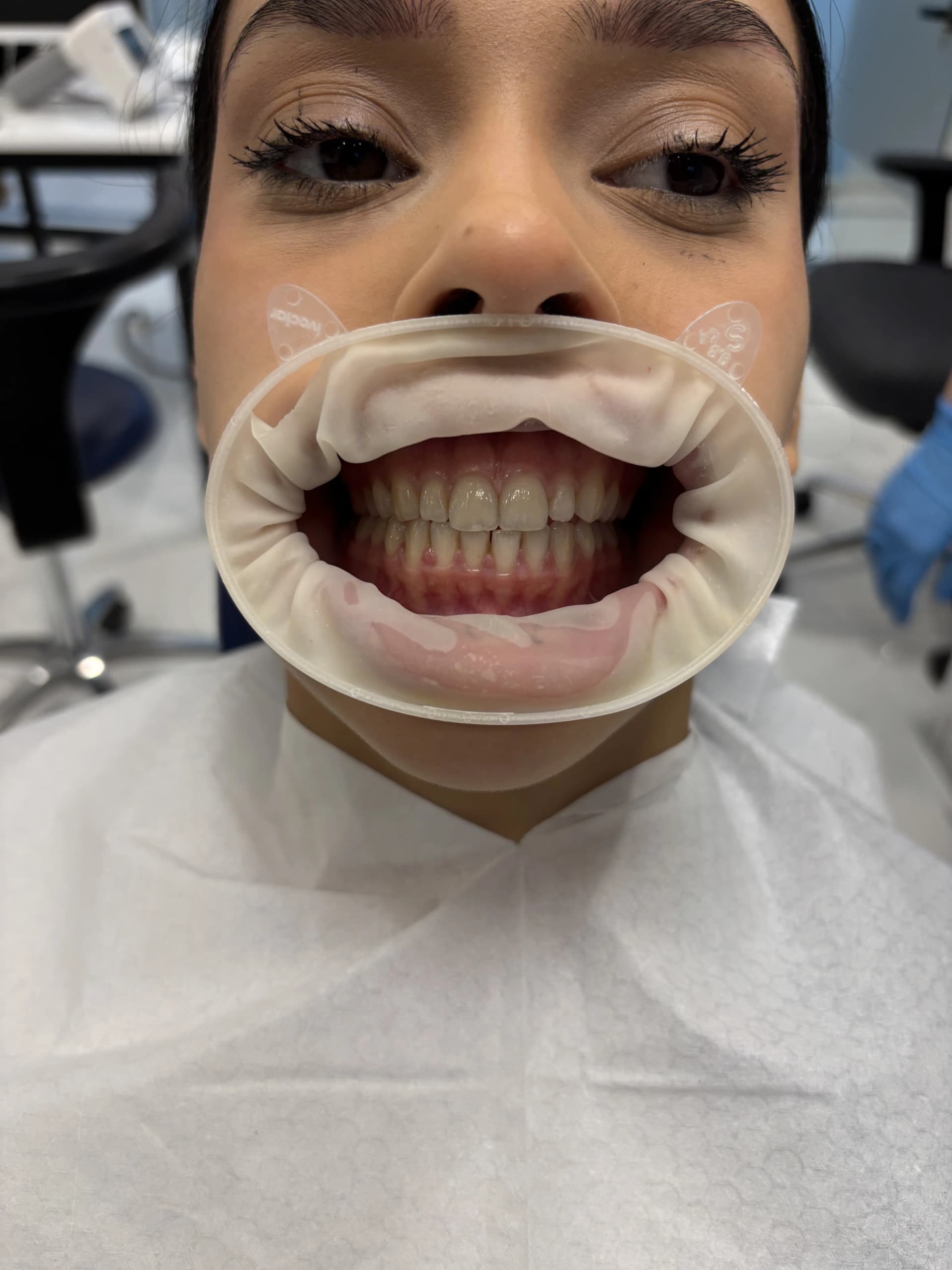 Composite bonding before case 5 — Istanbul