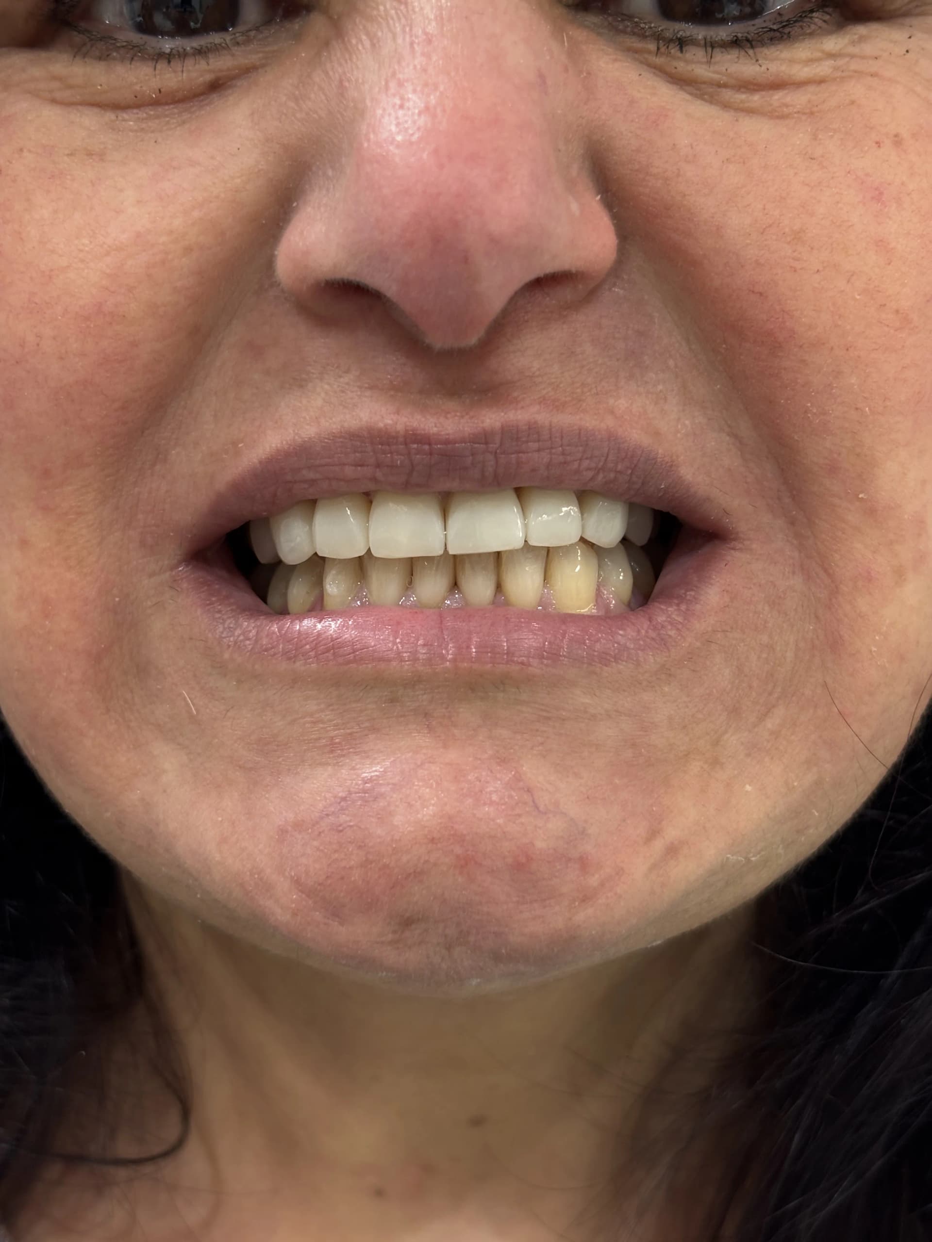 Composite bonding before case 6 — Istanbul