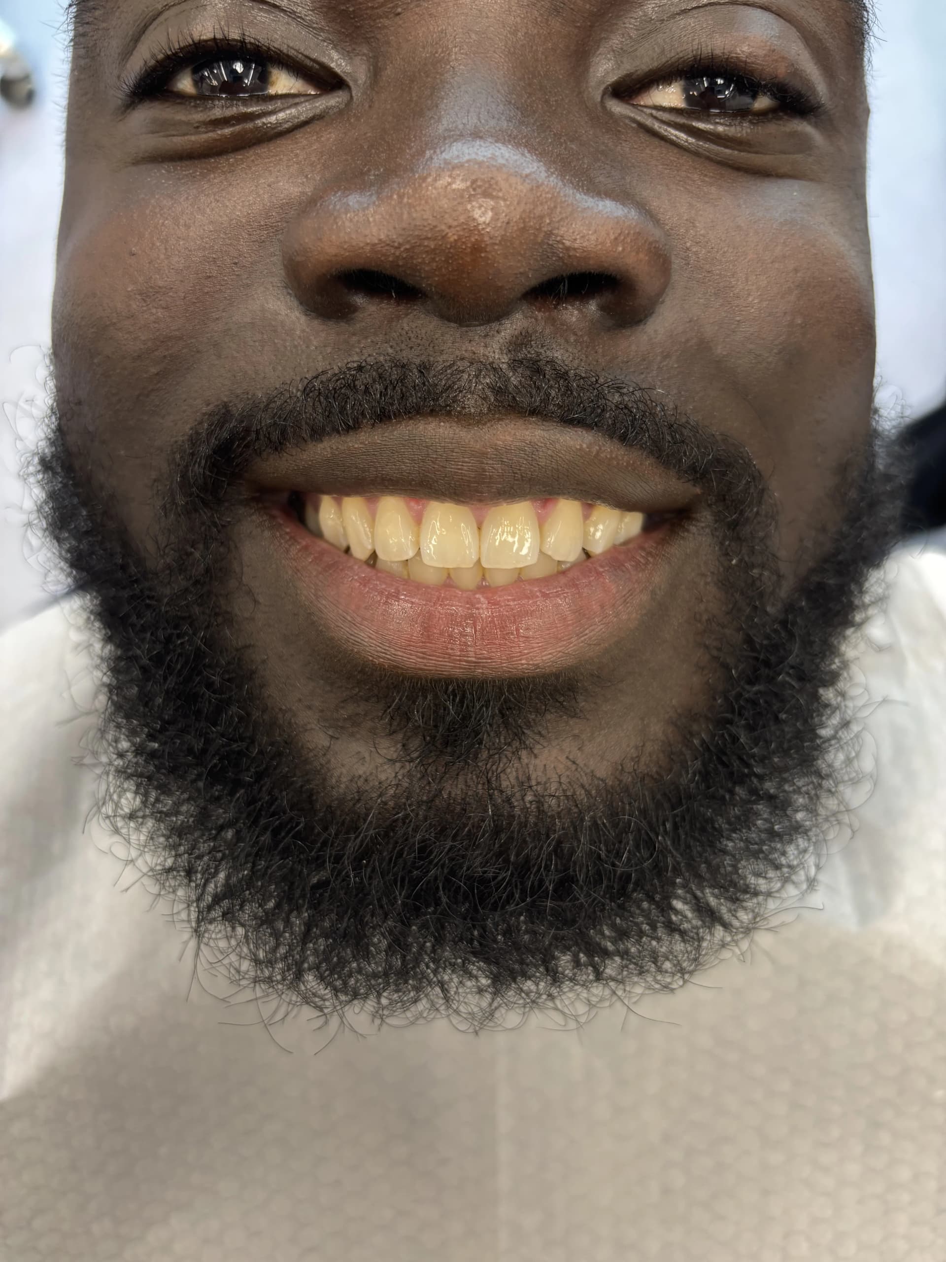 Composite bonding before case 7 — Istanbul