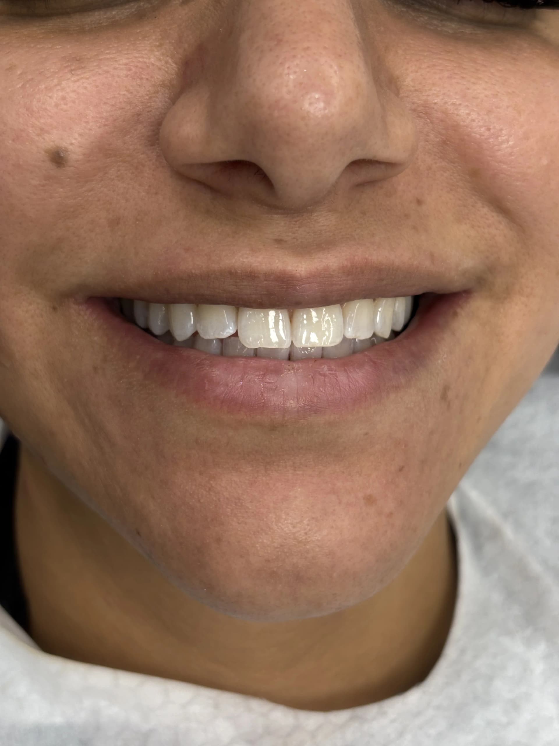 Composite bonding after case 8 — Istanbul NexWell