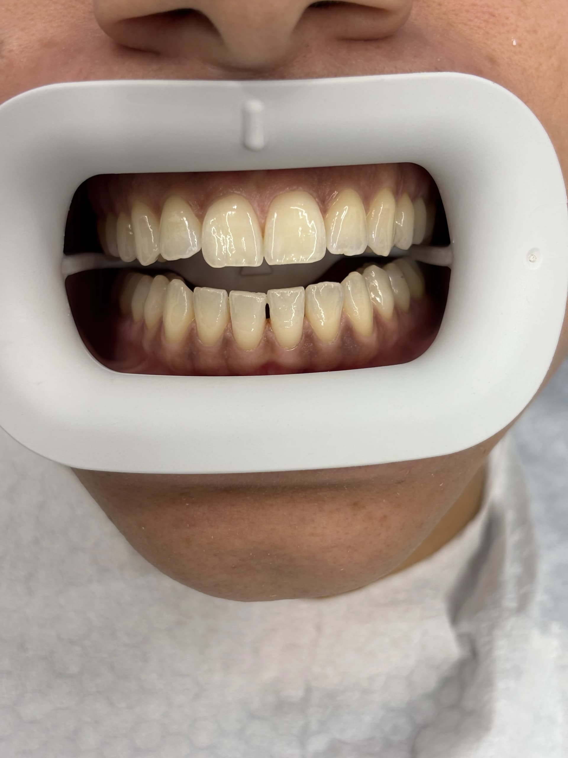 Composite bonding before case 8 — Istanbul