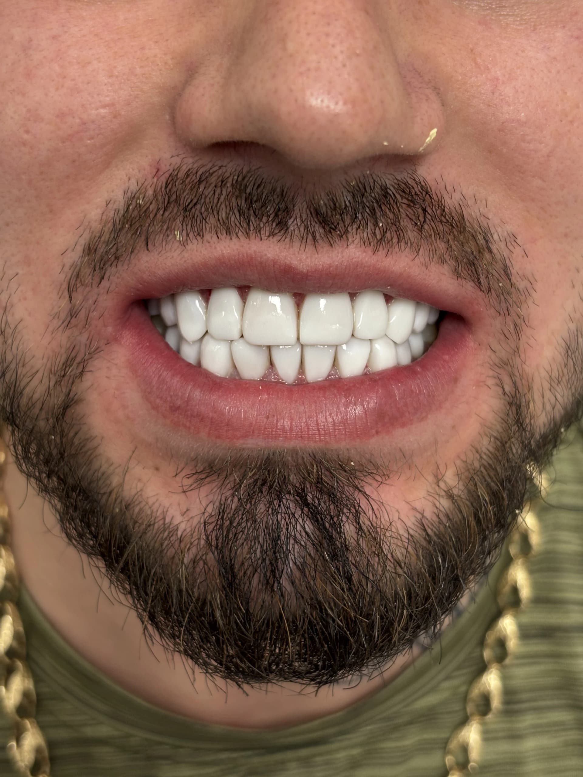 Composite bonding after case 9 — Istanbul NexWell