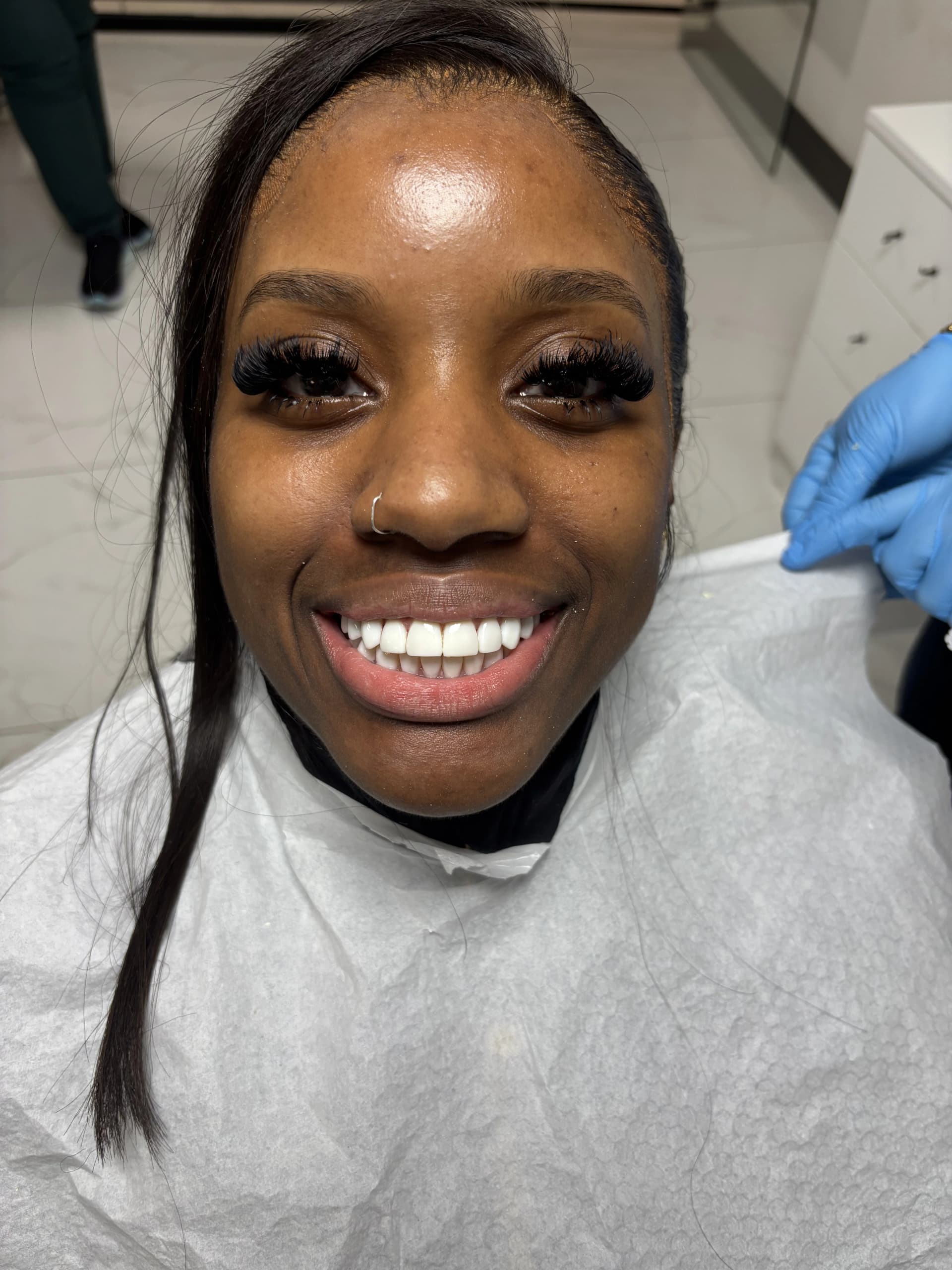Composite bonding after case 10 — Istanbul NexWell