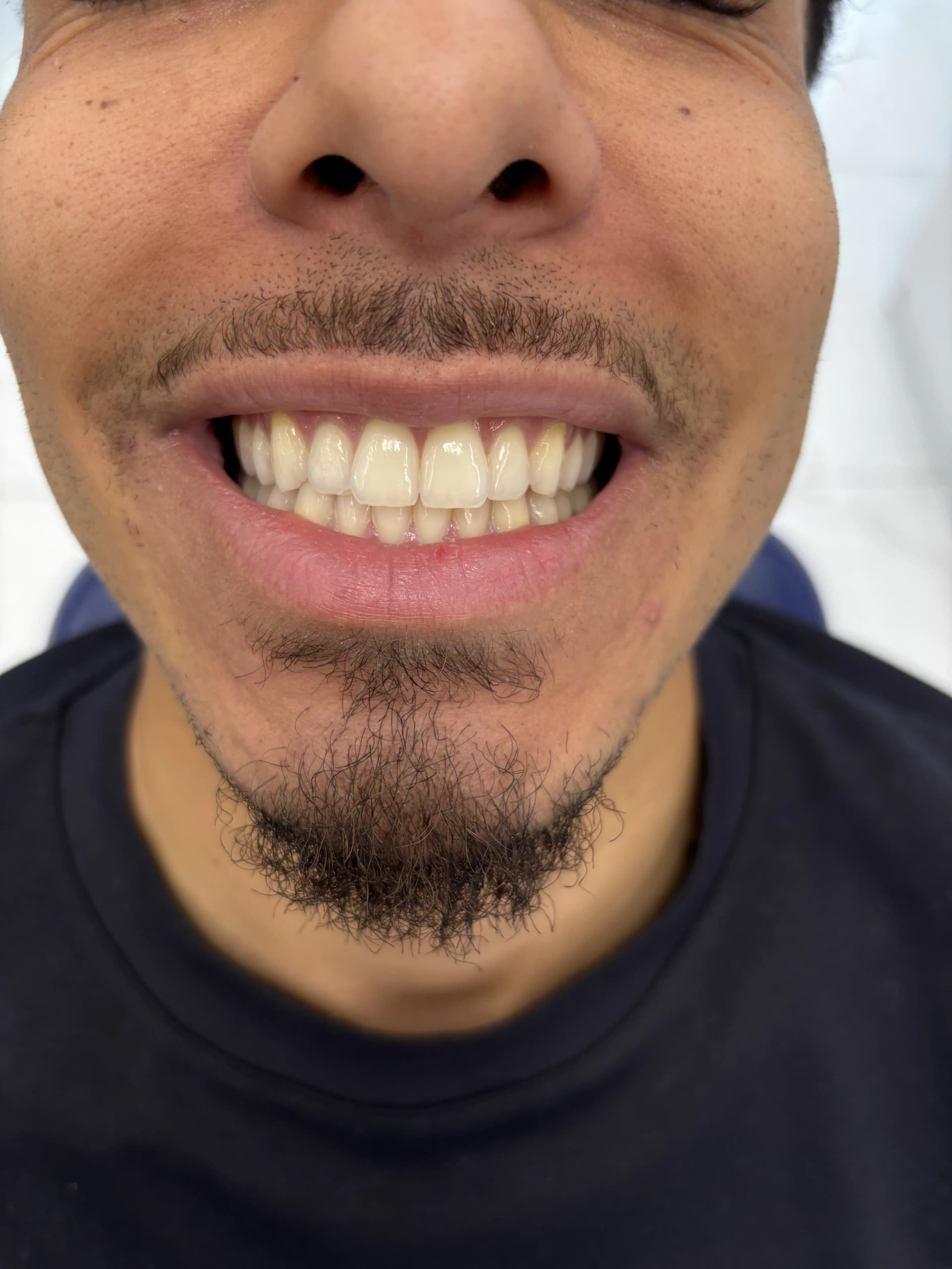 Composite bonding before case 13 — Istanbul