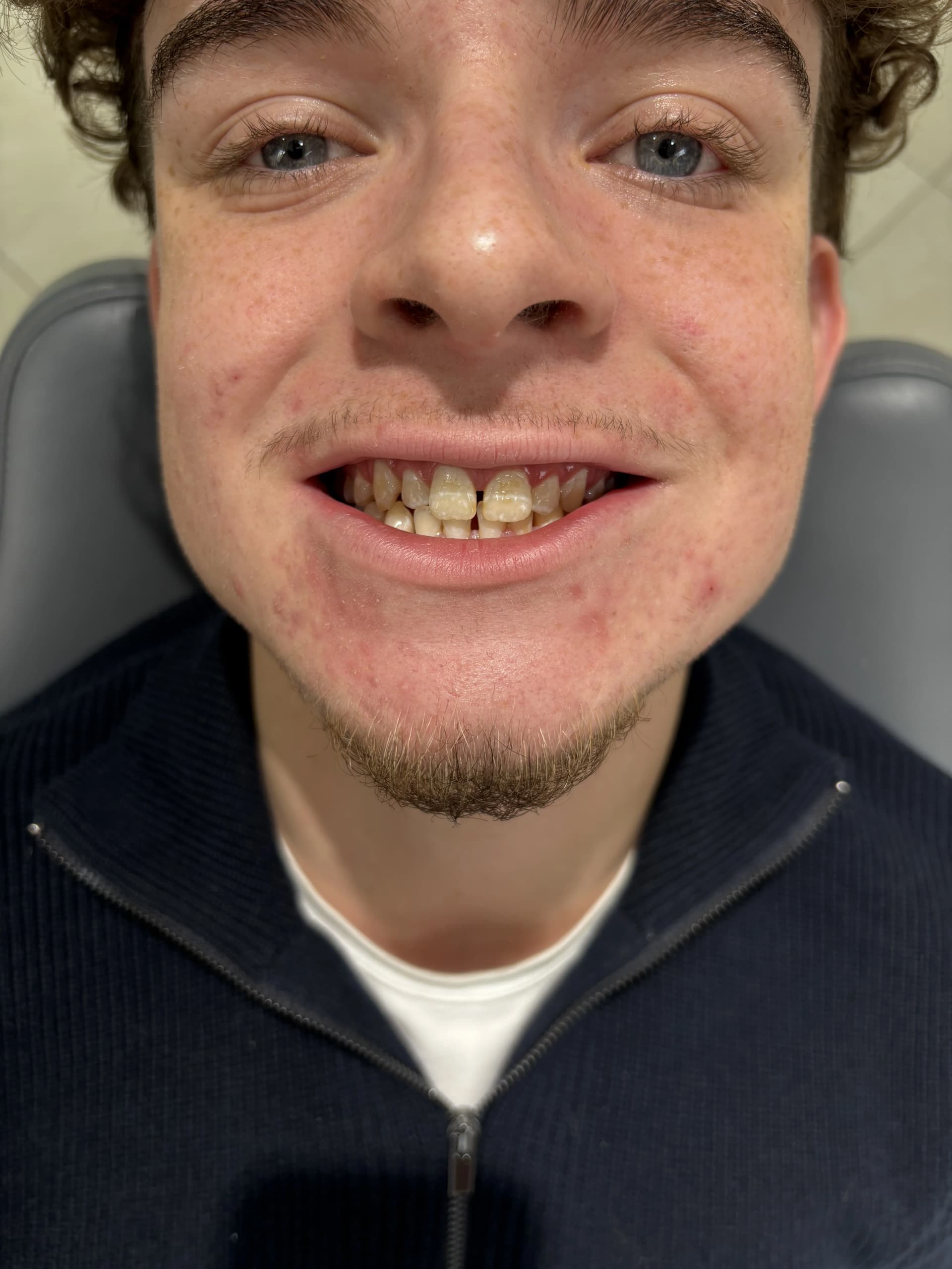 Composite bonding before case 15 — Istanbul