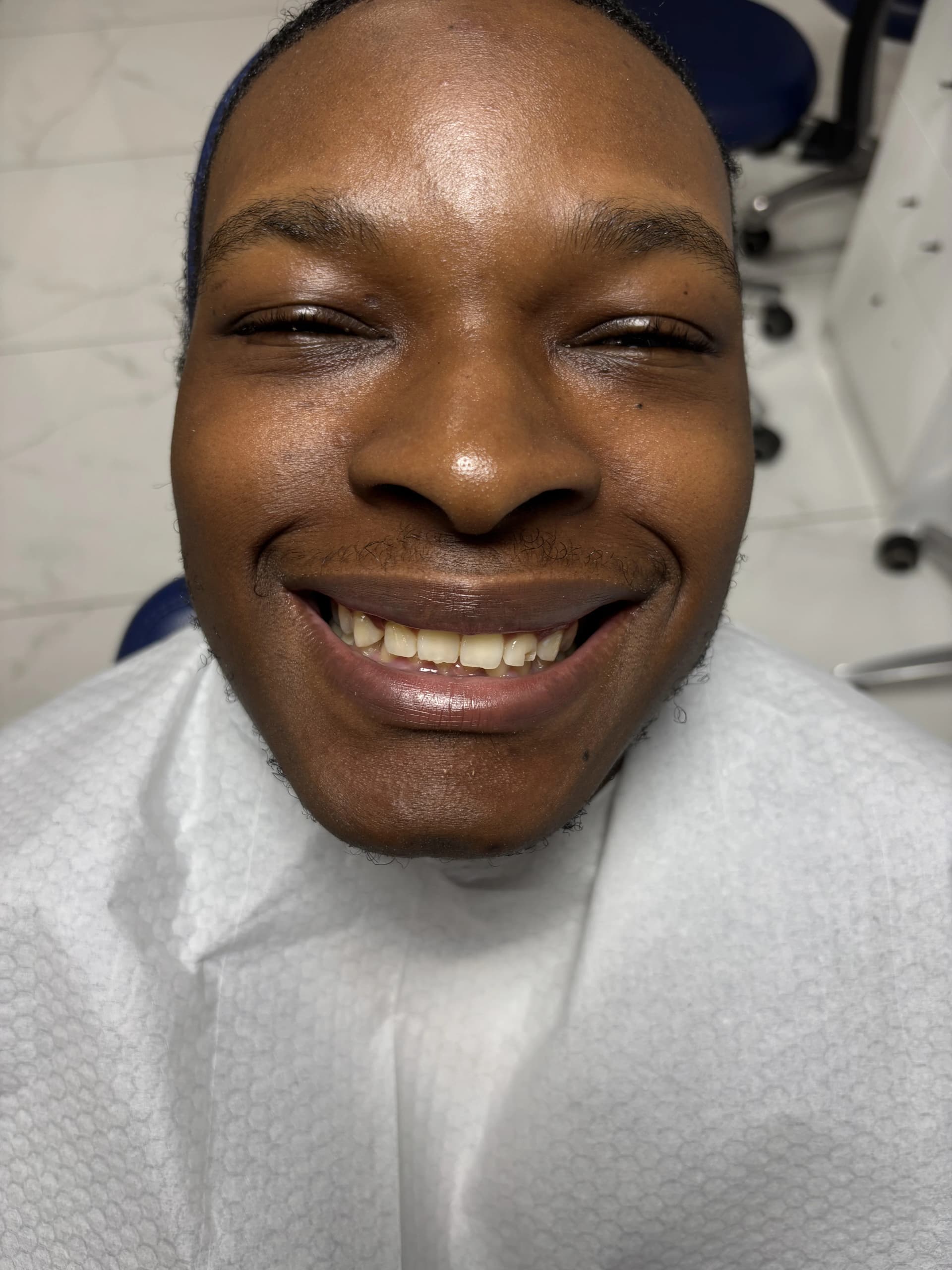 Composite bonding before case 17 — Istanbul