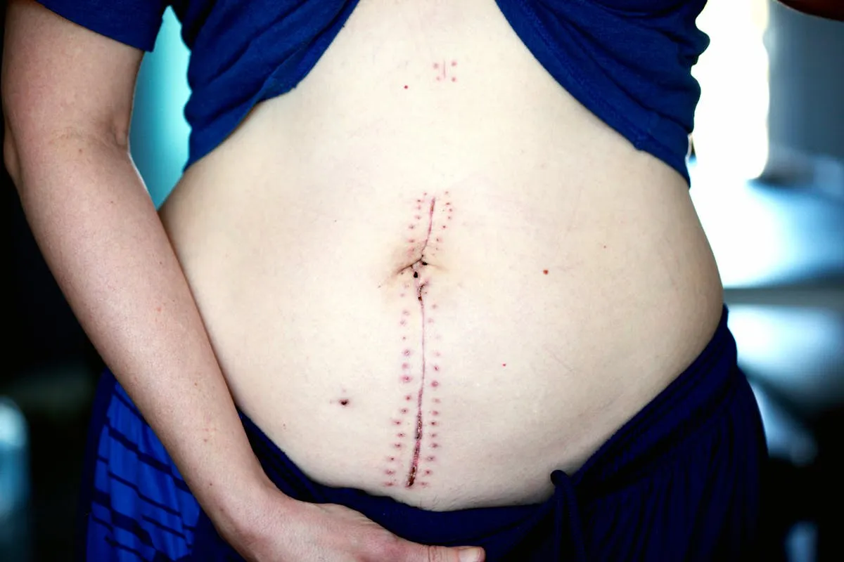 Mommy makeover procedure planning and recovery guide in Turkey