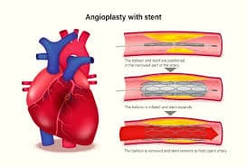 angioplasty in turkey