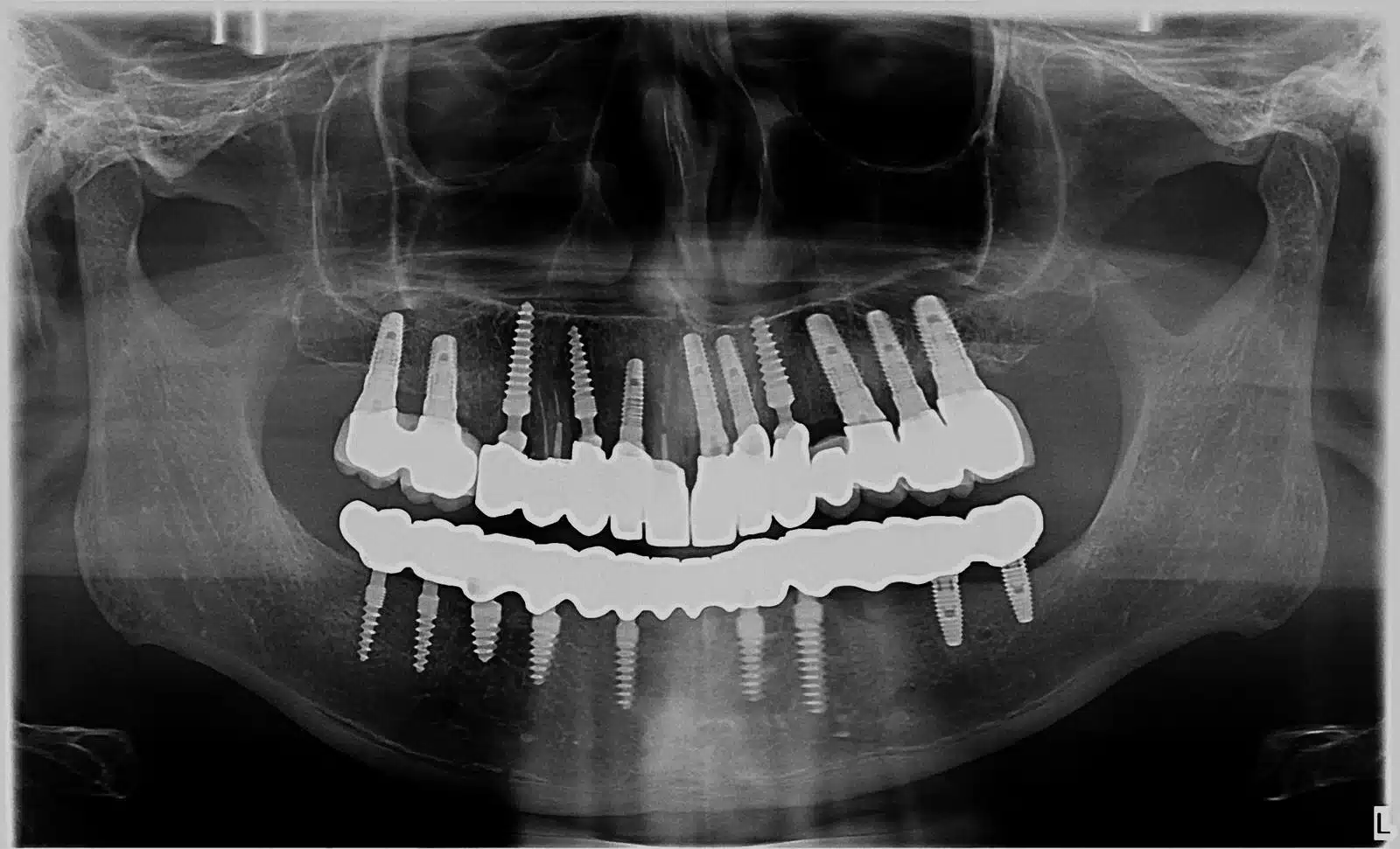 Tom Cruise smile makeover and Hollywood teeth transformation