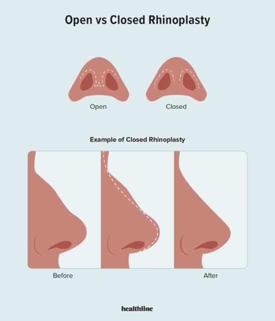 Rhinoplasty Turkey Cost 2026: Nose Job Prices, Types & What to Expect