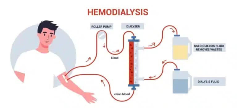 dialysis