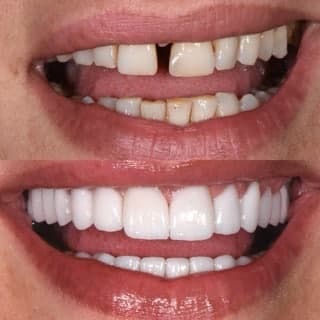 hollywood smile
