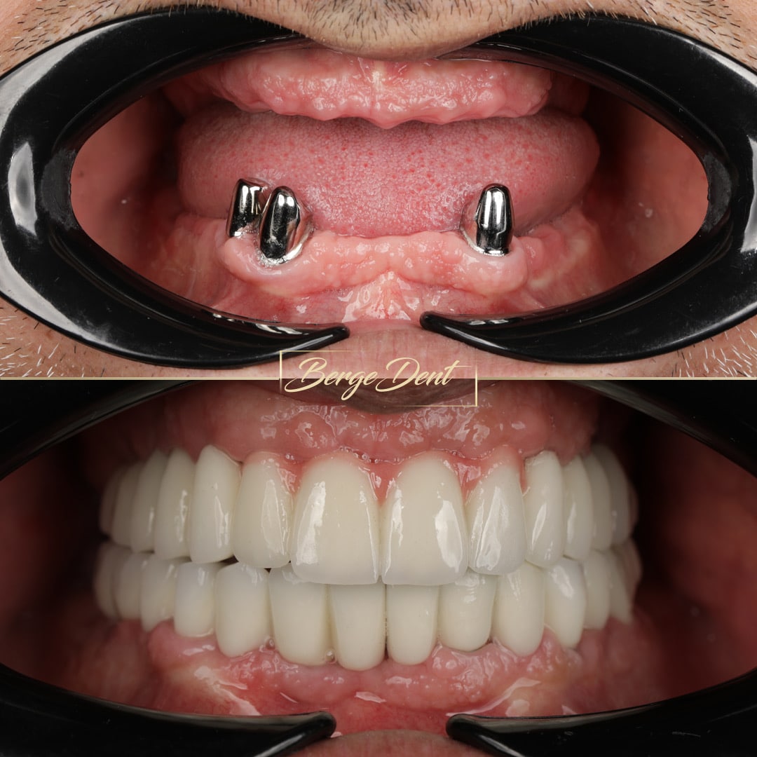Corticobasal Implants for Full Mouth Restoration