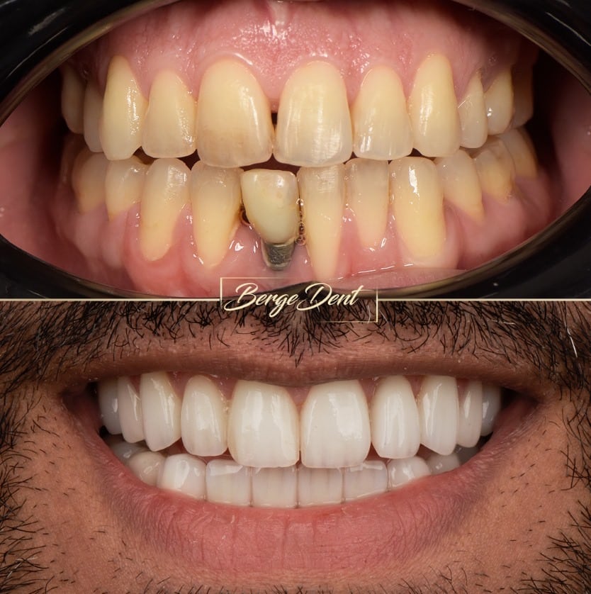 Corticobasal Implants for Full Mouth Restoration