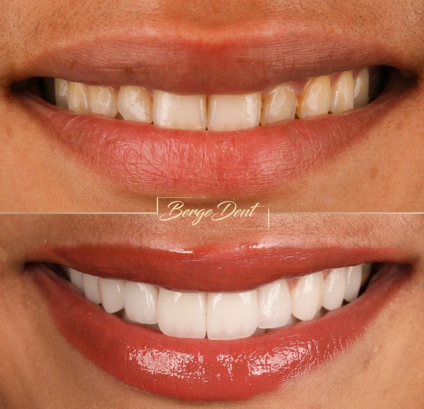 Corticobasal Implants for Full Mouth Restoration