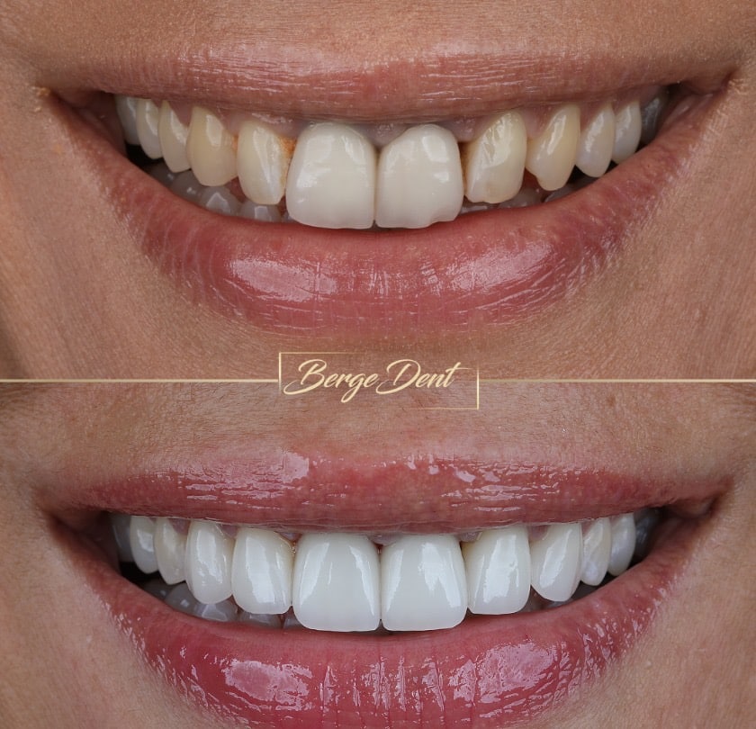Zirconia Crowns in Turkey: Advantages, Procedure, and Cost Overview