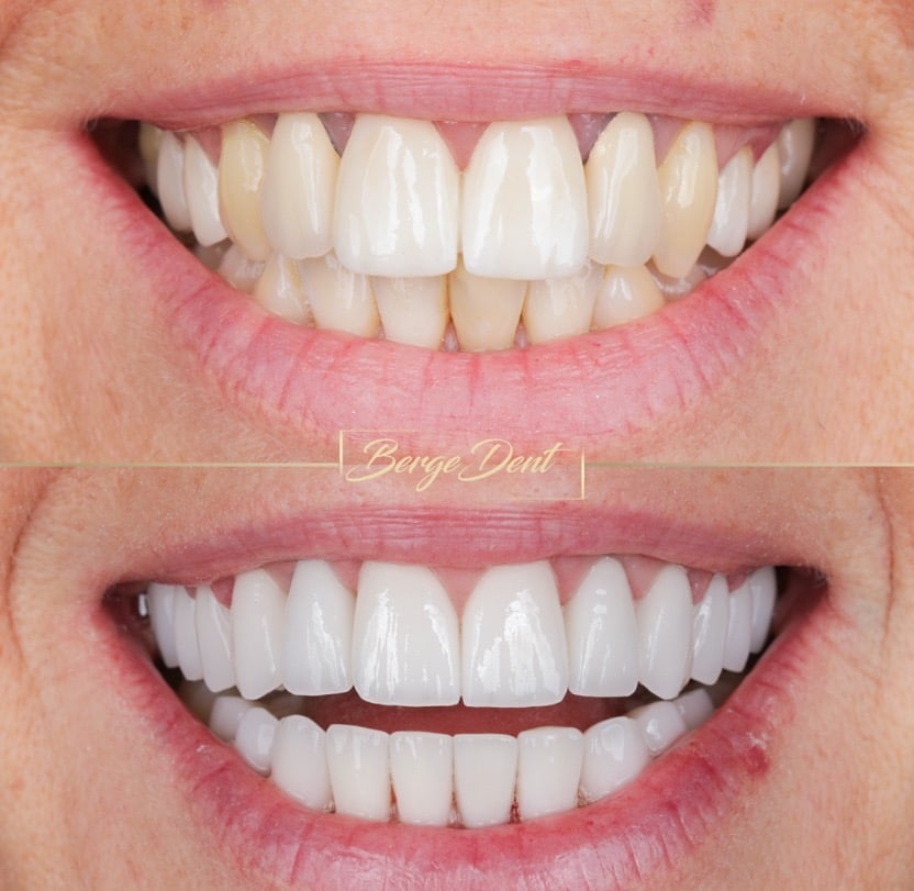 Types of Full Mouth Implant Systems