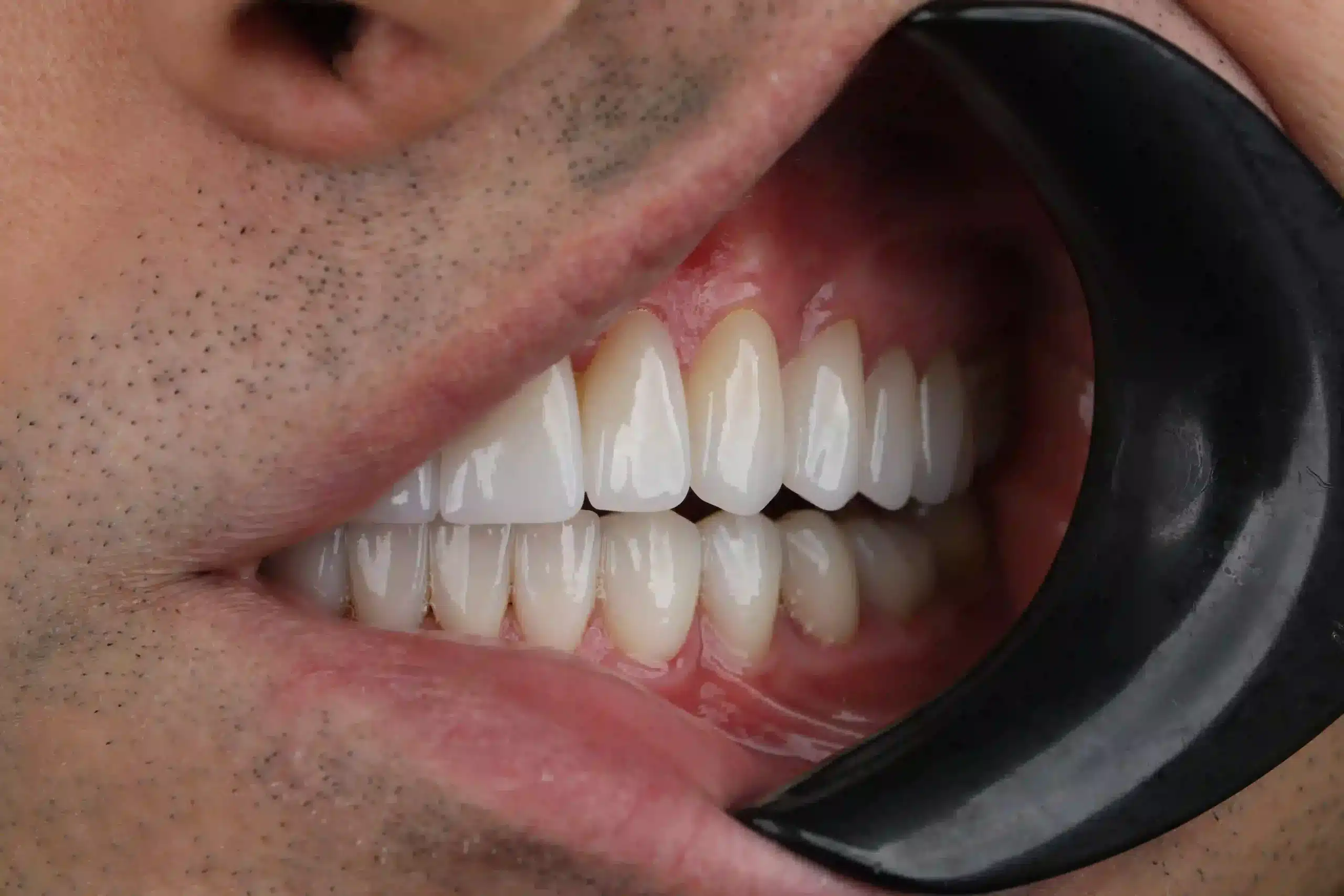 Full Mouth Dental Implants in Turkey