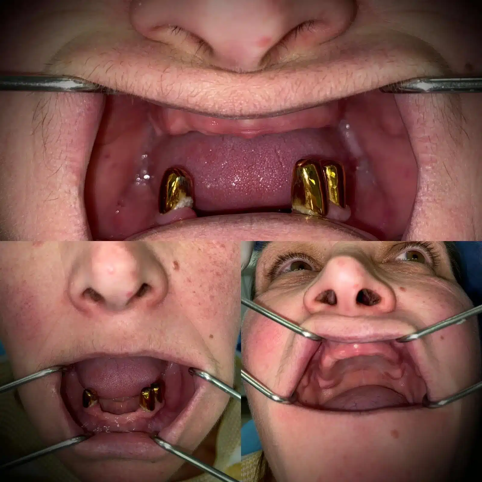 Full Mouth Restoration With Corticobasal Implants