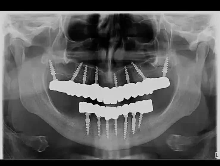 Full Mouth With Corticobasal Implants
