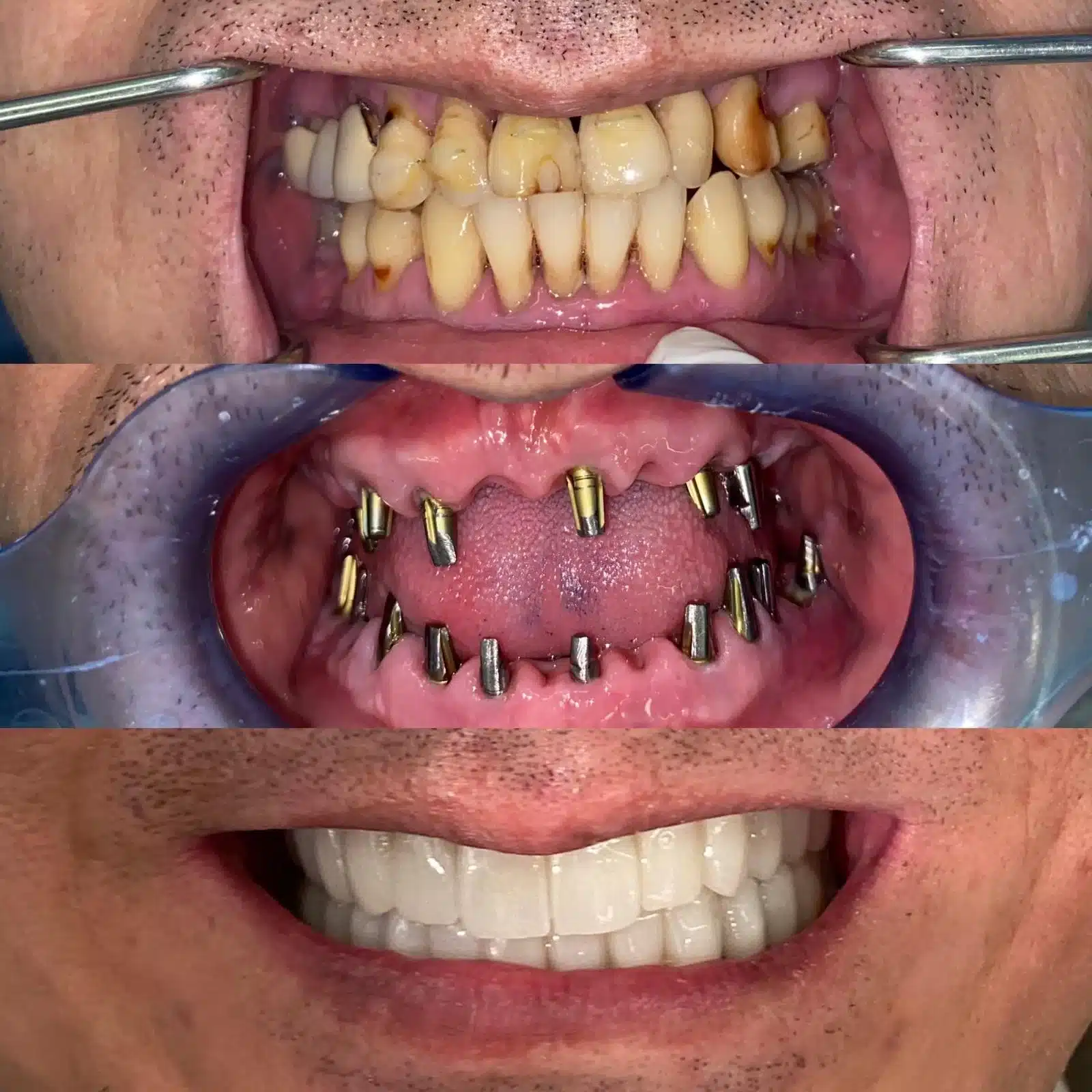 3-Day Full Mouth Restoration With Corticobasal Implants