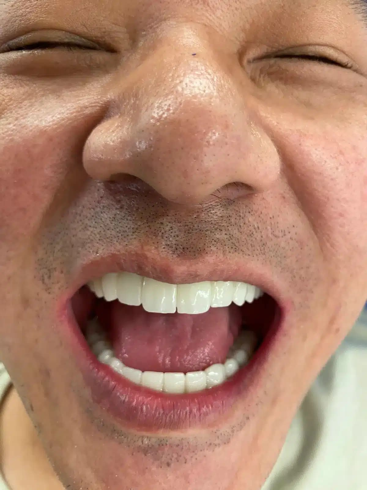 Full Mouth Restoration With Corticobasal Implants
