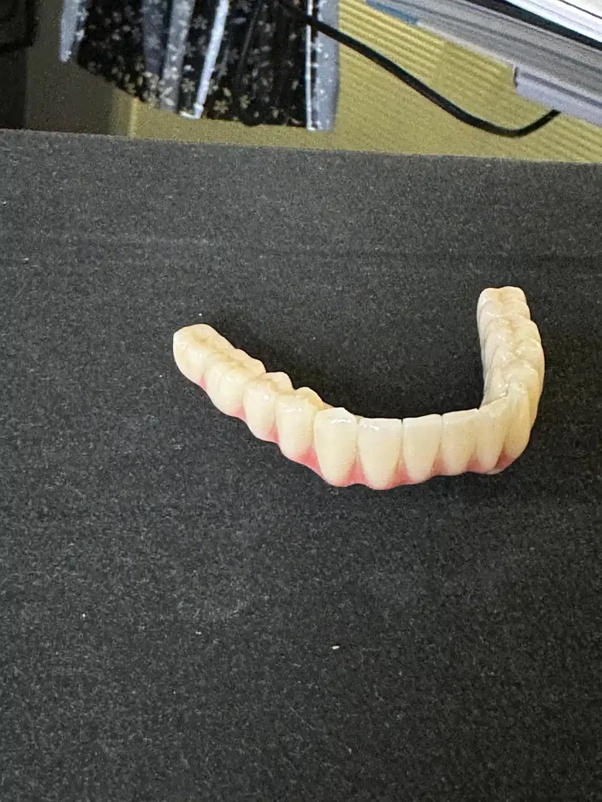 Full Mouth Restoration With Corticobasal Implants
