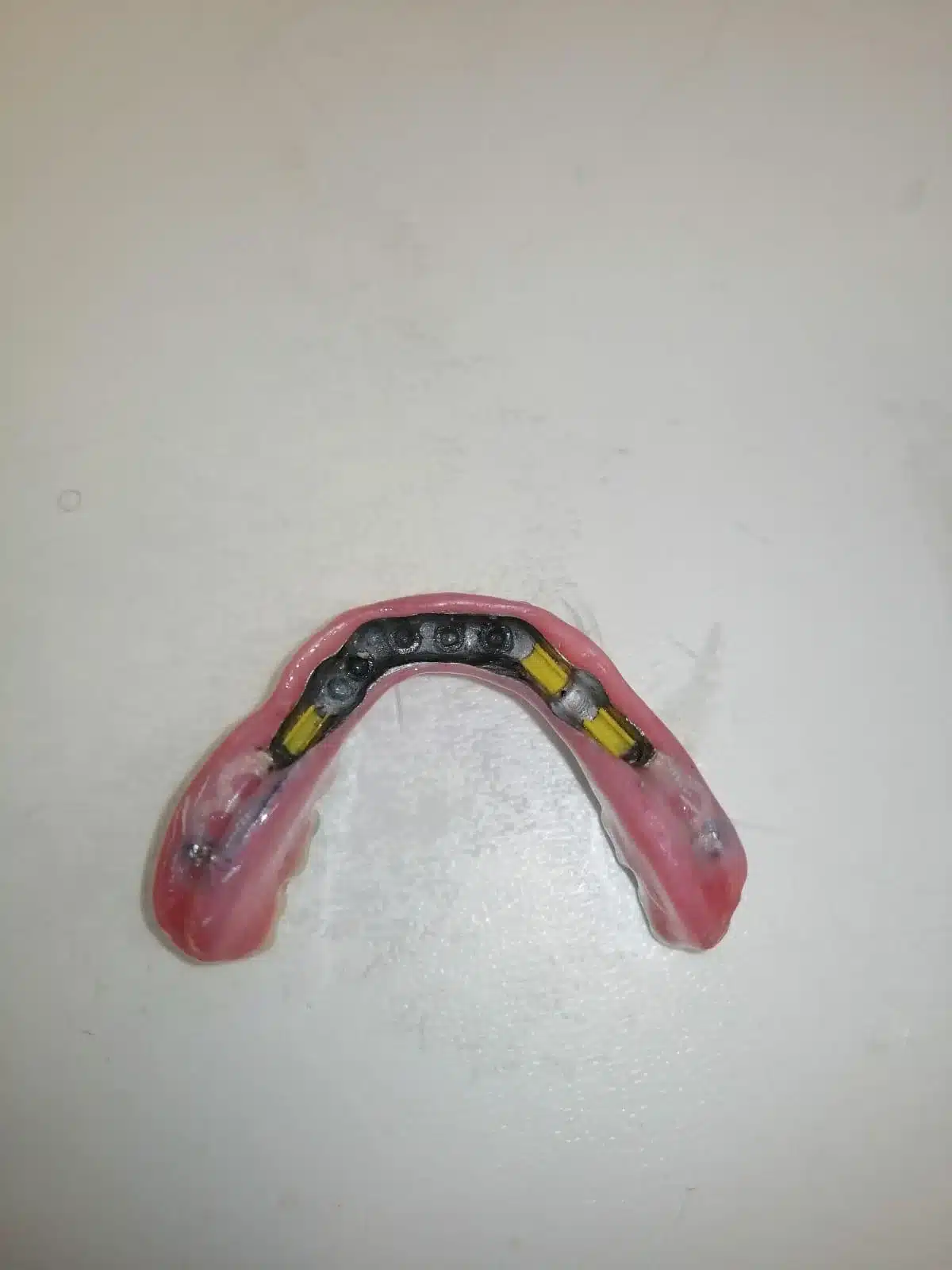 3-Day Full Mouth Restoration With Corticobasal Implants