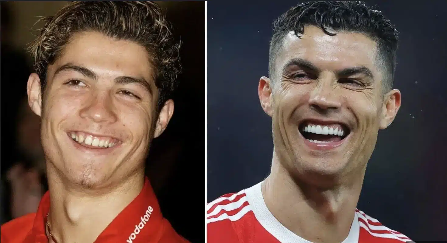 Cristiano Ronaldo Smile Makeover