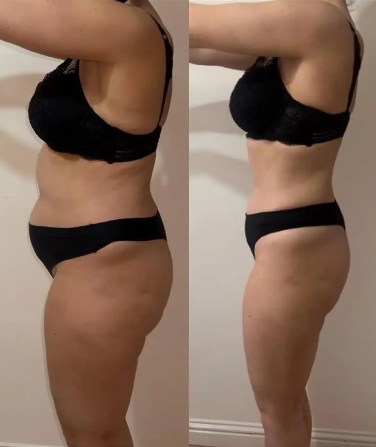 Diagram comparing Fleur-de-Lis and Extended Tummy Tuck incision patterns