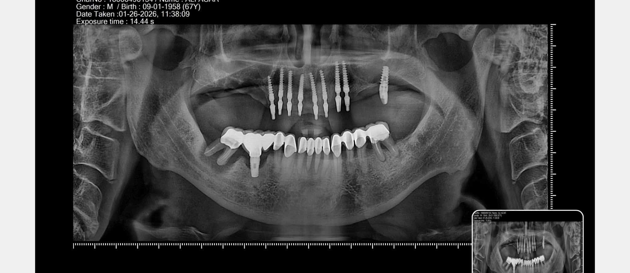 dr mehmet salih yıldırım corticobasal implants