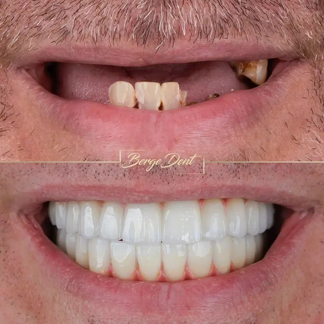 full mouth implants in turkey